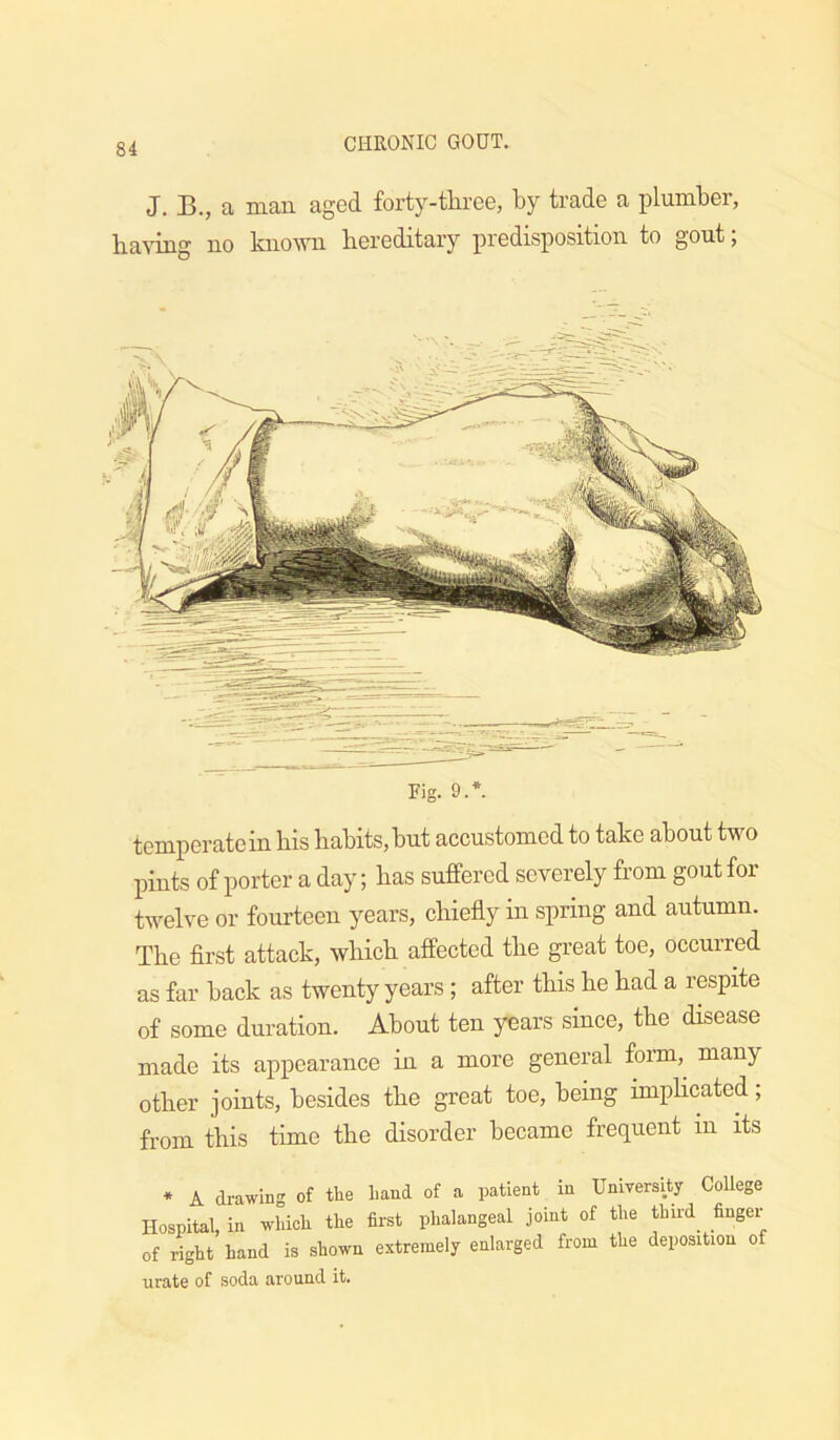 J. B., a man aged forty-tliree, by trade a plumber, having no known hereditary predisposition to gout; Fig. 9.*. temperate in his habits, but accustomed to take about two pints of porter a day; has suffered severely from gout for twelve or fourteen years, chiefly m spring and autumn. The flrst attack, which affected the great toe, occurred as far back as twenty years; after this he had a respite of some duration. About ten years since, the disease made its appearance in a more general fonn,^ many other joints, besides the great toe, being imphcated; from this time the disorder became frequent in its * A drawing of the Land of a patient in University College Hospital, in whicL the first phalangeal joint of the third finger of right hand is shown extremely enlarged from the deposition of urate of soda around it.