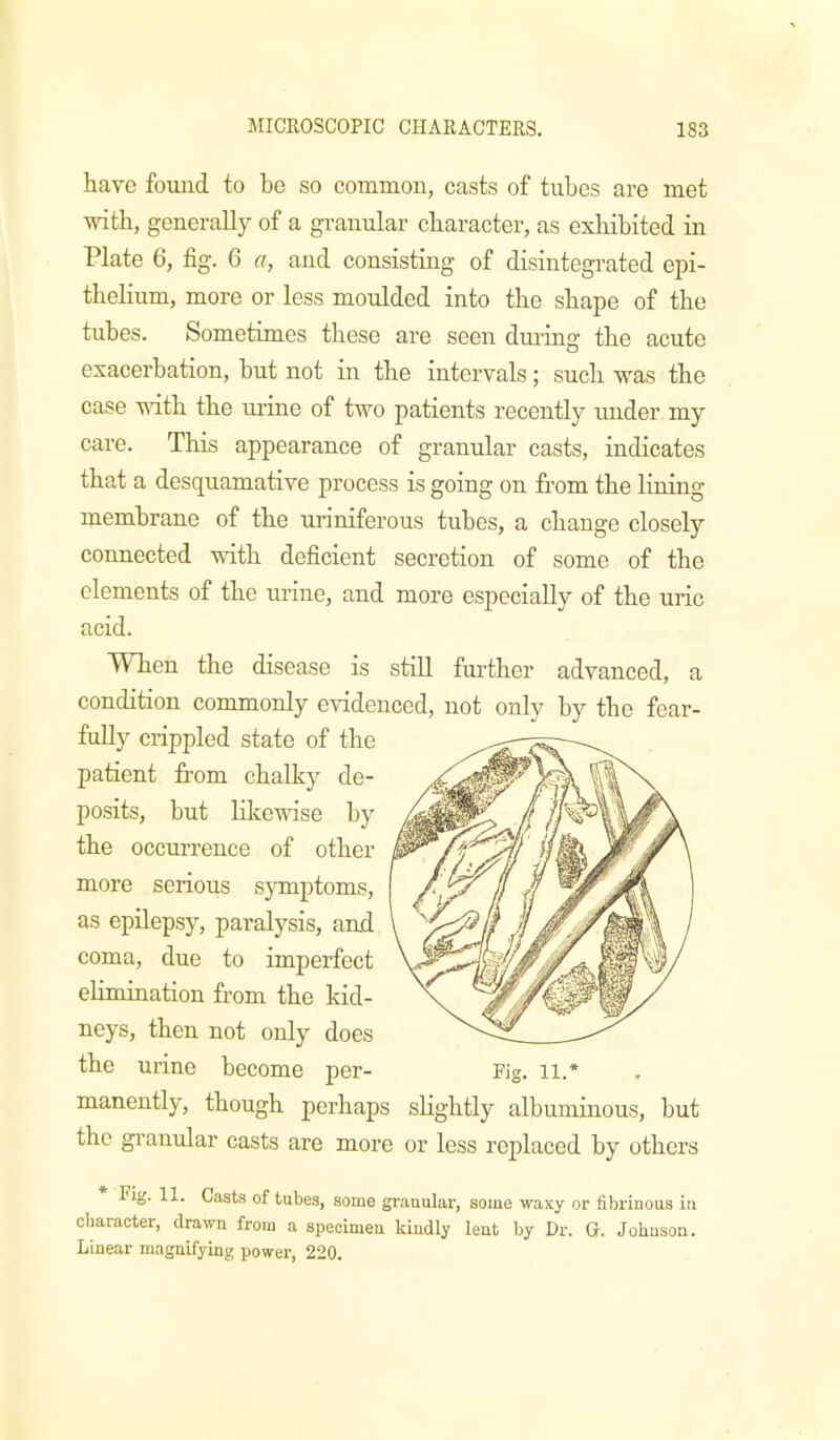 have found to be so common, casts of tubes are met with, generally of a granular character, as exlribited in Plate 6, fig. 6 a, and consisting of disintegrated ejii- thelium, more or less moulded into the shape of the tubes. Sometimes these are seen dming the acute exacerbation, but not in the intervals; snch was the case wdth the urine of two patients recently under my care. This appearance of granular casts, indicates that a desquamative process is going on from the lining membrane of the uriniferous tubes, a change closely connected with deficient secretion of some of the elements of the urine, and more especially of the uric acid. When the disease is stiU further advanced, a condition commonly evidenced, not only by the fear- fully crippled state of the patient from chalky de- posits, but Idcewise by the occurrence of other more serious symptoms, as epilepsy, paralysis, and coma, due to imperfect elimination from the kid- neys, then not only does the urine become per- Fig. ii.* manently, though perhaps slightly albuminous, but the granular casts are more or less replaced by others Fig. 11. Casts of tubes, some granular, some waxy or fibrinous in character, drawn from a specimen kindly lent by Dr. G. Johnson. Linear magnifying power, 220.