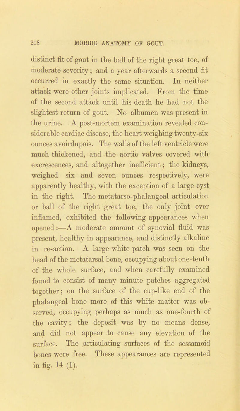 distinct fit of gout in the ball of the right great toe, of moderate severity; and a year afterwards a second fit occurred in exactly the same situation. In neither attack were other joints implicated. From the time of the second attack until his death he had not the sHghtest return of gout. No albumen was present in the urine. A post-mortem examination revealed con- siderable cardiac disease, the heart weighing twenty-six ounces avoirdupois. The walls of the left ventricle were much thickened, and the aortic valves covered with excrescences, and altogether inefficient; the kidneys, weighed six and seven ounces respectively, were apparently healthy, with the exception of a large cyst in the right. The metatarso-phalangeal articulation or ball of the right great toe, the only joint ever inflamed, exhibited the following appearances when opened:—A moderate amount of synovial fluid was present, healthy in appearance, and distinctly alkaline in re-action. A large white patch was seen on the head of the metatarsal bone, occupying about one-tenth of the whole surface, and when carefully examined found to consist of many minute patches aggregated together; on the surface of the cup-like end of the phalangeal bone more of this white matter was ob- served, occupying perhaps as much as one-fourth of the cavity; the deposit was by no means dense, and did not appear to cause any elevation of the surface. The articulating surfaces of the sessamoid hones were free. These appearances are represented in fig. 14 (1).