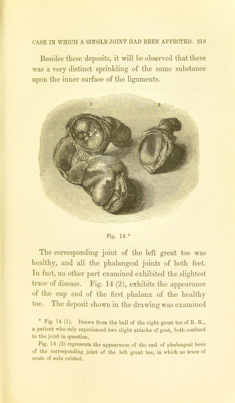 Besides these deposits, it will be observed that there was a very distinct sprinkbng of the same substance upon the inner surface of the ligaments. Fig. 14.* The corresponding joint of the left great toe was healthy, and all the phalangeal joints of both feet. In fact, no other part examined exhibited the slightest trace of disease. Fig. 14 (2), exhibits the appearance of the cup end of the first phalanx of the healthy toe. The deposit shown in the drawing was examined * Fig. 14 (1). Drawn from the ball of the right great toe of R. R., a patient who only experienced two slight attacks of gout, both confined to the joint in question. Fig. 14 (2) represents the appearance of the end of phalangeal bone of the corresponding joint of the left great toe, in which no trace of urate of soda existed.