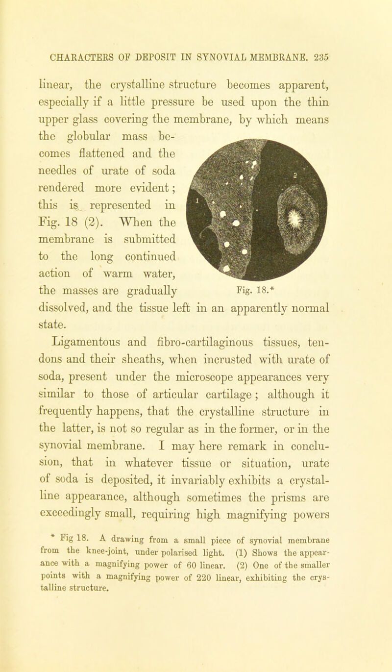 linear, the crystalline structure becomes apparent, especially if a little pressure be used upon the thin upper glass covering the membrane, by which means the globular mass be- comes flattened and the needles of urate of soda rendered more evident; this is^ represented in Fig. 18 (2). When the membrane is submitted to the long continued action of warm water, the masses are gradually Fig. 18.* dissolved, and the tissue left in an apparently normal state. Ligamentous and fibro-cartilaginous tissues, ten- dons and their sheaths, when incrusted with urate of soda, present under the microscope appearances very similar to those of articular cartilage ; although it frequently happens, that the crystalline structure in the latter, is not so regular as in the former, or in the synovial membrane. I may here remark in conclu- sion, that in whatever tissue or situation, luate of soda is deposited, it invariably exhibits a crystal- line appearance, although sometimes the prisms are exceedingly small, requiiing high magnifying powers Fig 18. A drawing from a small piece of synovial membrane from the knee-joint, under polarised light. (1) Shows the appear- ance with a magnifying power of 60 linear. (2) One of the smaller points with a magnifying power of 220 linear, exhibiting the crys- talline structure.