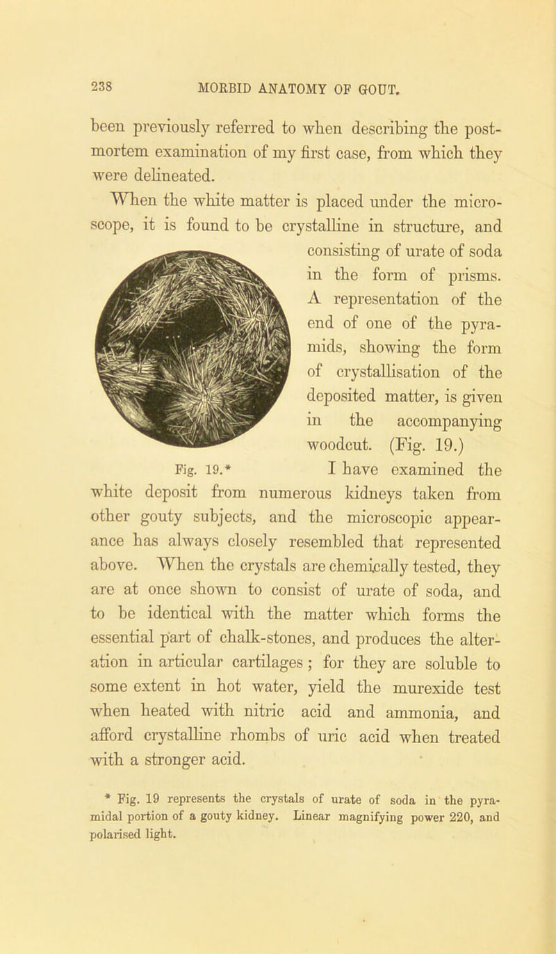 been previously referred to when describing the post- mortem examination of my first case, from which they were dehneated. When the white matter is placed under the micro- scope, it is found to he crystalline in structure, and consisting of urate of soda in the form of prisms. A representation of the end of one of the pyra- mids, showing the form of crystalhsation of the deposited matter, is given in the accompanying woodcut. (Fig. 19.) Fig. 19.* I have examined the white deposit from numerous Iddneys taken from other gouty subjects, and the microscopic appear- ance has always closely resembled that represented above. When the crystals are chemically tested, they are at once shown to consist of urate of soda, and to be identical with the matter which forms the essential part of chalk-stones, and produces the alter- ation in articular cartilages; for they are soluble to some extent in hot water, yield the murexide test when heated with nitric acid and ammonia, and afford crystaUine rhombs of uric acid when treated with a stronger acid. * Fig. 19 represents the crystals of urate of soda in the pyra- midal portion of a gouty kidney. Linear magnifying power 220, and polarised light.