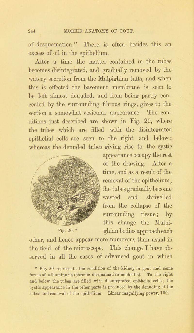 of desquamation.” There is often besides this an excess of oil in the epithelium. After a time the matter contained in the tubes becomes disintegrated, and gradually removed by the watery secretion from the Malpighian tufts, and when this is effected the basement membrane is seen to be left almost denuded, and from being partly con- cealed by the surrounding fibrous rings, gives to the section a somewhat vesicular appearance. The con- ditions just described are shown in Fig. 20, where the tubes which are filled with the disintegrated epithelial cells are seen to the right and below; whereas the denuded tubes giving rise to the cystic appearance occupy the rest of the drawing. After a time, and as a result of the removal of the epithehum, the tubes gradually become wasted and shrivelled from the collapse of the surrounding tissue; by this change the Malpi- Fig. 20. * ghian bodies approach each other, and hence appear more numerous than usual in the field of the microscope. This change I have ob- served in all the cases of advanced gout in which * Fig. 20 represents the condition of the kidney in gout and some forms of albuminuria (chronic desquamative nephritis). To the right and below the tubes are fdled with disintegrated epithelial cells; the cystic appearance in the other parts is produced by the denuding of the tubes and removal of the epithelium. Linear magnifying power, 100.