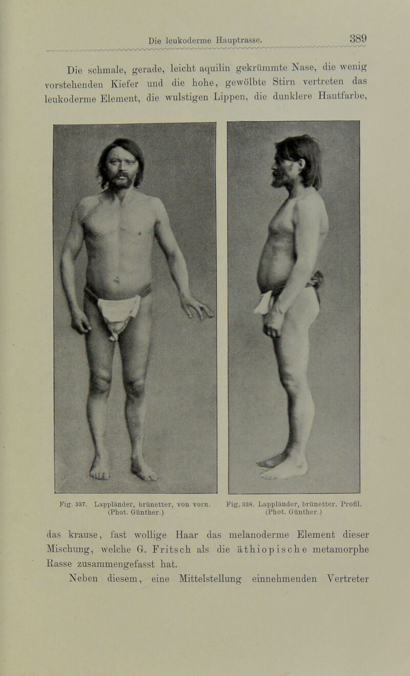 Die sckmale, gerade, leiclit aquilin gekriimmte Nase, die wenig vorstekenden Kiefer und die koke, gewolbte Stirn vertreten das leukoderme Element, die wulstigen Lippen, die dunklere Hautfarbe, Fig. 337. Lappl&nder, brunetter, von vorn. Fig. 338. Iiappliinder, brunetter. Profil. (Phot. Gunther.) (Phot. Gunther.) das krause, fast wollige Haar das melanoderme Element dieser Misckung, welcke G. Fritsck als die atkiopiscke metamorpke Rasse zusammengefasst kat. Neben diesem, eine Mittelstellung einnekmenden Yertreter