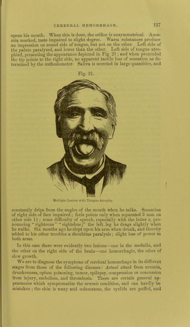 opens his mouth. When this is done, the orifice is unsymmetrical. Anos- mia marked, taste impaired to slight degree. Warm substances produce an impression on sound side of tongue, but not on the other. Left side of the palate paralyzed, and lower than the other. Left side of tongue atro- phied, presenting the appearance depicted in Fig. 21; and when protruded the tip points to the right side, no apparent tactile loss of sensation as de- termined by the testhesiometer. Saliva is secreted in large quantities, and Fig. 21. Multiple Lesion with Tongue Atrophy. constantly drips from the angles of the mouth when he talks. Sensation of right side of face impaired ; feels points only when separated 3 mm. on other side H ; some difficulty of speech, especially with the letter r, pro- nouncing  righteous   eightshusthe left leg he drags slightly when he walks. Six months ago he slept upon his arm when drunk, and thereby added to his other troubles a decubitus paralysis; slight loss of power in both arms. In this case there were evidently two lesions—one in the medulla, and the other on the right side of the brain—one hemorrhagic, the other of slow growth. We are to diagnose the symptoms of cerebral hemorrhage in its different stages from those of the following diseases: Actual attack from uraemia, drunkenness, opium poisoning, tumor, epilepsy, compression or concussion from injury, embolism, and thrombosis. There are certain general ap- pearances which symptomatize the urcemic condition, and can hardly be mistaken ; the skin is waxy and oedematous, the eyelids are puffed, and