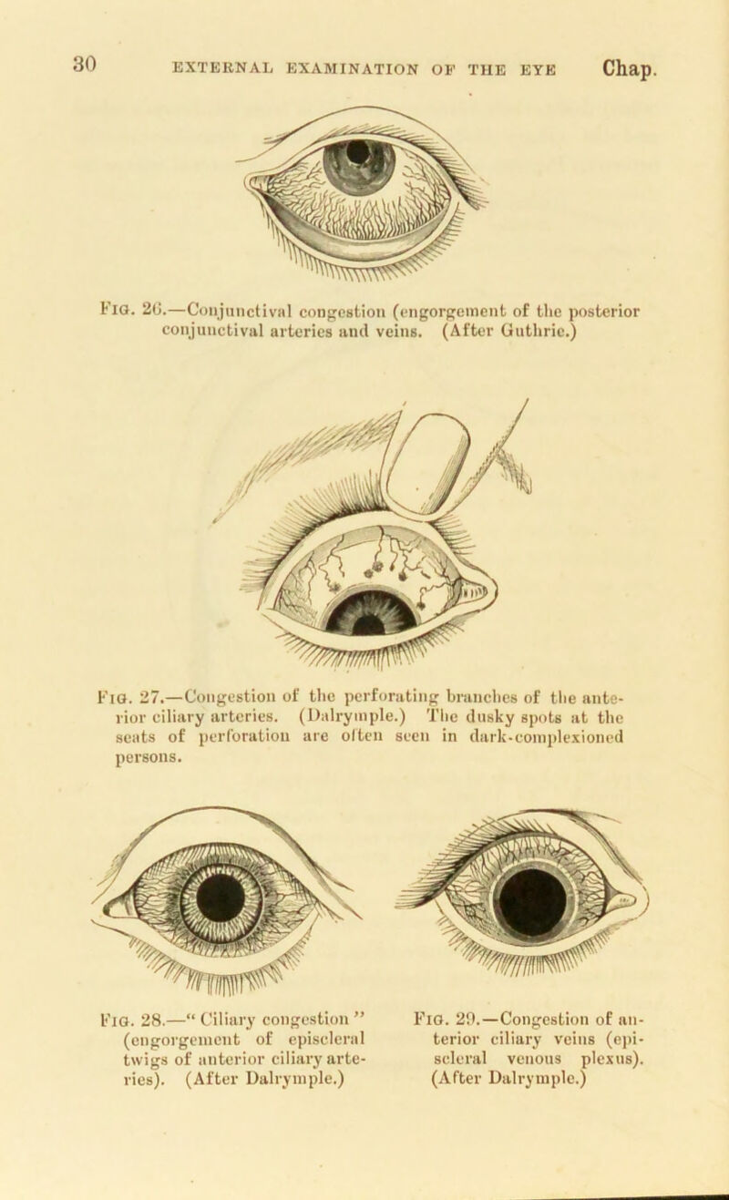 Fio. 20.—Conjunctival congestion (engorgement of the posterior conjunctival arteries and veins. (After Guthrie.) Fig. 27.—Congestion of the perforating branches of the ante- rior ciliary arteries. (Dairymple.) The dusky spots at the seats of perforation are often seen in dark-complexioned persons. Fig. 28.—“ Ciliary congestion ” (engorgcincnt of episcleral twigs of anterior ciliary arte- ries). (After Dalryinple.) Fig. 20.—Congestion of an- terior ciliary veins (epi- scleral venous plexus). (After Dalryinple.)