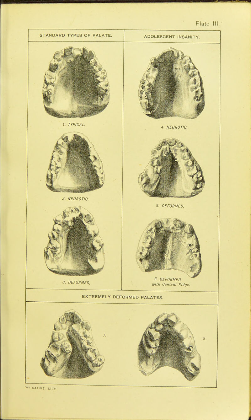 STANDARD TYPES OF PALATE. 3. DEFORMED, ADOLESCENT INSANITY. with Central Ridge. EXTREMELY DEFORMED PALATES.