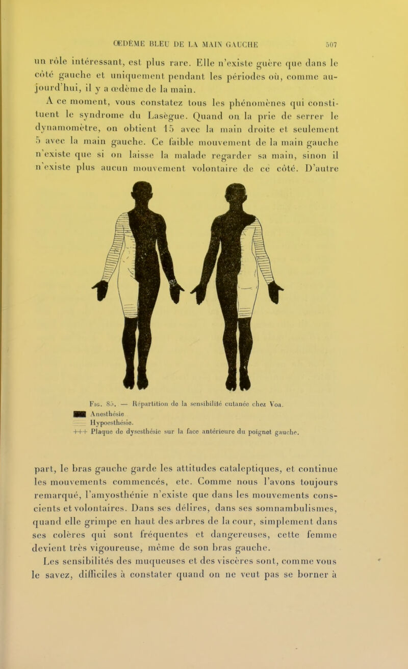 un rôle intéressant, est plus rare. Elle n'existe guère que dans le côté gauche et uniquement pendant les périodes où, comme au- jourd'hui, il y a œdème de la main. A ce moment, vous constatez tous les phénomènes qui consti- tuent le syndrome du Lasègue. Quand on la prie de serrer le dynamomètre, on obtient 15 avec la main droite et seulement 5 avec la main gauche. Ce faible mouvement de la main gauche n'existe que si on laisse la malade regarder sa main, sinon il n'existe plus aucun mouvement volontaire de ce côté. D'autre FiG. 8.1. — Répartition de la sensibilité cutanée chez Voa. H Anesthésie •-^ Hypoesthésie. +++ Plaque de dysesthésic sur la face antérieure du poignet gauche. part, le bras gauche garde les attitudes cataleptiques, et continue les mouvements commencés, etc. Comme nous l'avons toujours remarqué, l'amyosthénie n'existe que dans les mouvements cons- cients et volontaires. Dans ses délires, dans ses somnambulismes, quand elle grimpe en haut des arbres de la cour, simplement dans ses colères qui sont fréquentes et dangereuses, cette femme devient très vigoureuse, même de son bras gauche. Les sensibilités des muqueuses et des viscères sont, comme vous le savez, difficiles ii constater quand on ne veut pas se borner à