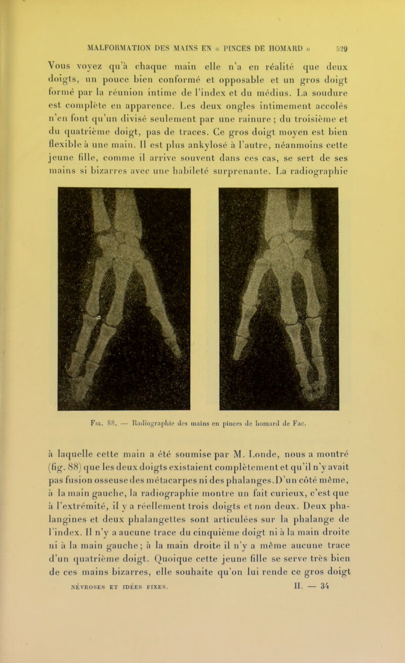 Vous voyez qu'à chaque main elle n'a en réalité que deux doigts, un pouce bien conformé et opposable et un gros doigt formé par la réunion intime de l'index et du médius, La soudure est complète en apparence. Les deux ongles intimement accolés n'eu lont qu'un divisé seulement par une rainure; du troisième et du quatrième doigt, pas de traces. Ce gros doigt moyen est bien flexible à une main. Il est plus ankylosé h l'autre, néanmoins cette jeune fdle, comme il arrive souvent dans ces cas, se sert de ses mains si bizarres avec une habileté surprenante. La radiographie FiG. 88. — Radiograpliie des mains on pinces do lioinaril de Fac. à laquelle cette main a été soumise par M. Londe, nous a montré (fig. 88) que les deux doigts existaient complètement et qu'il n'y avait pas fusion osseusedes métacarpes ni des phalanges.D'un côté même, à la main gauche, la radiographie montre un fait curieux, c'est que à l'extrémité, il y a réellement trois doigts et non deux. Deux pha- langines et deux phalangettes sont articulées sur la phalange de l'index. Il n'y a aucune trace du cinquième doigt ni à la main droite ni à la main gauche; à la main droite il n'y a même aucune trace d'un quatrième doigt. Quoique cette jeune fille se serve très bien de ces mains bizarres, elle souhaite qu'on lui rende ce gros doigt NÉVROSES ET IDEES FIXES. II. 34