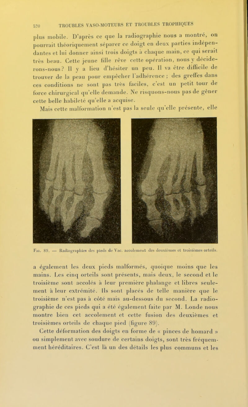 plus mobile. D'après ce que la radiographie nous a montré, on pourrait théoriquement séparer ce doigt en deux parties indépen- dantes et lui donner ainsi trois doigts à chaque main, ce ciui serait très beau. Cette jeune fille rêve cette opération, nons y décide- rons-nous? Il y a lieu d'hésiter un peu. Il va être difficile de trouver de la peau pour empêcher l'adhérence ; des greffes dans ces conditions ne sont pas très faciles, c'est un petit tour de force chirurgical qu'elle demande. Ne risquons-nous pas de gêner cette belle habileté qu'elle a acquise. Mais cette malformation n cst pas la seule (pi'elle présente, elle l' Kj. 8',). — liatliograpliics ilcs pieds de Vac. accolemciil des deuxièmes el Iroisièines orteils. a également les deux pieds malformés, quoique moins qne les mains. Les cinq orteils sont présents, mais deux, le second et le troisième sont accolés à leur première phalange et libres seule- ment à leur extrémité. Ils sont placés de telle manière que le troisième n'est pas à côté mais au-dessous du second. La radio- graphie de ces pieds qui a été également faite par M. Londe nous montre bien cet accolement et cette fusion des deuxièmes et troisièmes orteils de chaque pied (figure 89). Cette déformation des doigts en forme de « pinces de homard » ou simplement avec soudure de certains doigts, sont très fréquem- ment héréditaires. C'est là un des détails les plus cpmmuns et les