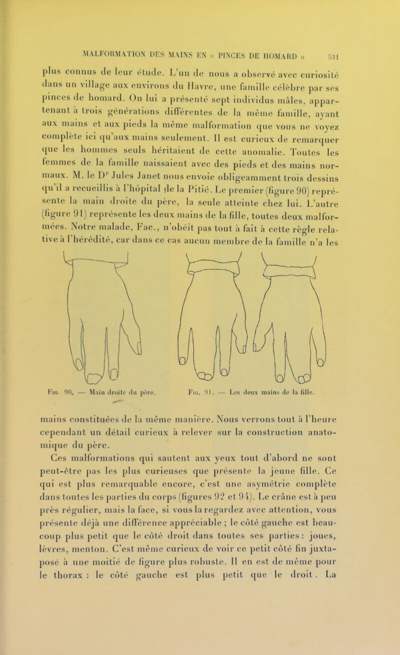 plus connus de leur étude. L'un de nous a observé avec curiosité dans un village aux environs du Havre, une famille célèbre par ses pinces de homard. On lui a présenté sept individus mâles, appar- tenant h trois générations différentes de la même famille, ayant aux mains et aux pieds la même malformation que vous ne voyez complète ici qu'aux mains seulement. Il est curieux de remarquer que les hommes seuls héritaient de cette anomalie. Toutes les femmes de la famille naissaient avec des pieds et des mains nor- maux. M. le D'' Jules Janet nous envoie obligeamment trois dessins qu'il a recueillis à l'hôpital de la Pitié. Le premier (figure 90) repré- sente la main droite du père, la seule atteinte chez lui. L'autre (figure 91) représente les deux mains de la fille, toutes deux malfor- mées. Notre malade, Fac, n'obéit pas tout à fait à cette règle rela- tive à l'hérédité, cardans ce cas aucun membre de la famille n'a les FiG. 90, — Main droite iln père. FiG. III. — Los deux mains de la fille. mains constituées de la même manière. Nous verrons tout à l'heure cependant un détail curieux à relever sur la construction anato- mique du père. Ces malformations qui sautent aux yeux tout d'abord ne sont peut-être pas les plus curieuses que présente la jeune fille. Ce qui est plus remarquable encore, c'est une asymétrie complète dans toutes les parties du coi'ps (figures 92 et 9 'i). Le crâne est à peu près régulier, mais la face, si vous la regardez avec attention, vous présente déjà une différence appréciable ; le côté gauche est beau- coup plus petit que le côté droit dans toutes ses parties: joues, lèvres, menton. C'est même curieux de voir ce petit côté fin juxta- posé à une moitié de figure plus robuste. Tl en est de même poul- ie thorax : le côté gauche est plus petit que le droit. La