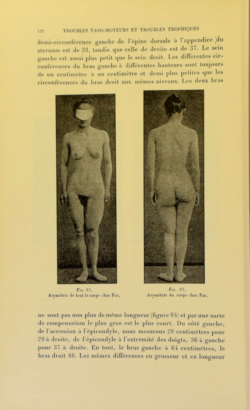 demi-circonférence gauche de l'épine dorsale à l'appendice ^du sternum est de 33, tandis que celle de droite est de 37. Le sein gauche est aussi plus petit que le sein droit. Les différentes cir- conférences du bras gauche à différentes hauteurs sont toujours de un centimètre à un centimètre et demi plus petites que les circonférences du bras droit aux mômes niveaux. Les deux bras FiG. 9?. Asymétrie de tout le corps chez F.ic. FiG. 93. Asymétrie du corps chez Fac. ne sont pas non plus de même longueur (figure 94) et par une sorte de compensation le plus gros est le plus court. Du côté gauche, de l'acromion à l'épicondyle, nous mesurons 28 centimètres pour 29 à droite, de l'épicondyle h l'extrémité des doigts, 36 à gauche pour 37 à droite. En tout, le bras gauche à 64 centimètres, le bras droit 66. Les mêmes différences en grosseur et en longueur