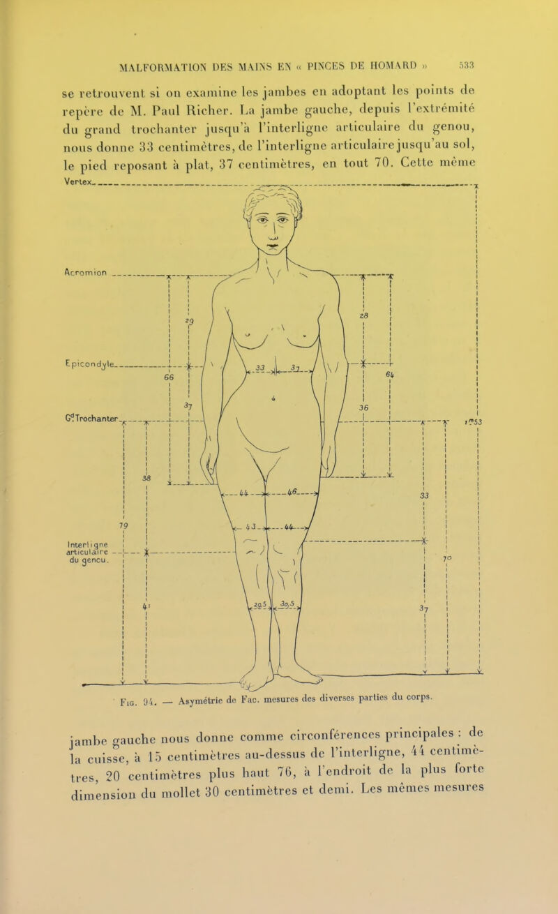 se retrouvent si on examine les jambes en adoptant les points do repère de M. Paul Richer. La jambe gauche, depuis l'extrémité du grand trochanter jusqu'à l'interligne articulaire du genou, nous donne 33 centimètres, de l'interligne articulaire jusqu'au sol, le pied reposant à plat, 37 centimètres, en tout 70. Cette même FiG. 94. — Asymétrie de Fac. mesures des diverses parties du corps. jambe gauche nous donne comme circonférences principales : de 1-, cuisse, à 15 centimètres au-dessus de l'interligne, 4 4 centimè- tres, 20 centimètres plus haut 76, à l'endroit de la plus forte dimension du mollet 30 centimètres et demi. Les mêmes mesures
