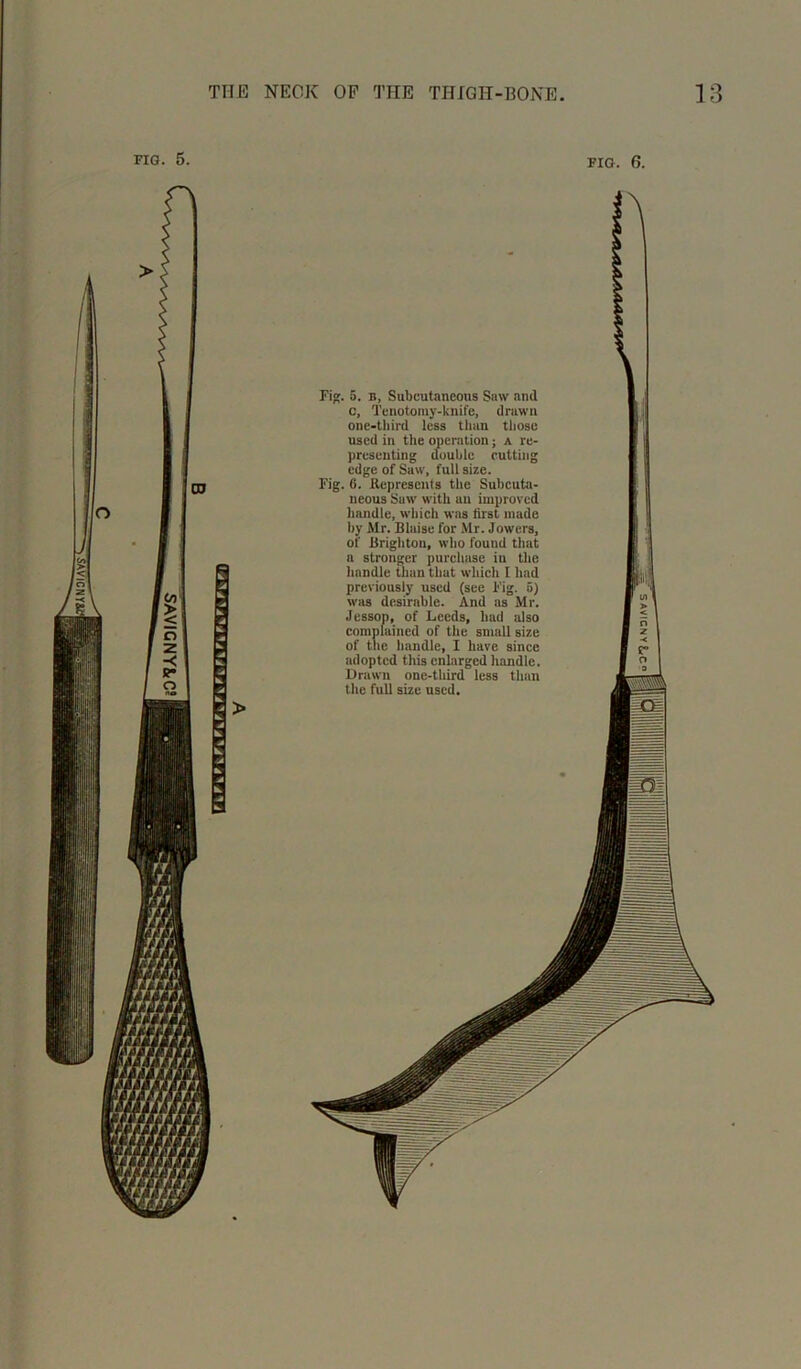 SAVIGNYiC? A Fig. 5. n, Subcutaneous Saw and c, Tenotomy-knife, drawn one-third less than those used in the operation; a re- presenting double cutting edge of Saw, full size. Fig. 6. Represents the Subcuta- neous Saw with an improved handle, which was first made hy Mr. Blaise for Mr. Jowers, of Brighton, who found that a stronger purchase iu the handle than that which I had previously used (see Fig. 5) was desirable. And as Mr. Jessop, of Leeds, had also complained of the small size of the handle, I have since adopted this enlarged handle. Drawn one-third less than the full size used.