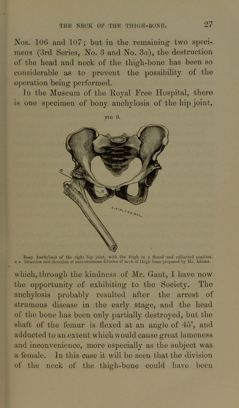 Nos. 106 and 107; but in the remaining two speci- mens (3rd Series, No. 3 and No. 3a), the destruction of the head and neck of the thigh-bone has been so considerable as to prevent the possibility of the operation being performed. In the Museum of the Royal Free Hospital, there is one specimen of bony anchylosis of the hip joint, FIG 9. Bony Anchylosis of the right hip joint, with the thigh in a flexed and adducted position. a a Situation aiid direction of subcutaneous division of neck of thigh-bone proposed by Mr. Adams. which, through the kindness of Mr. Gant, I have now the opportunity of exhibiting to the Society. The anchylosis probably resulted after the arrest of strumous disease in the early stage, and the head of the bone has been only partially destroyed, but the shaft of the femur is flexed at an angle of 45°, and adducted to an .extent which would cause great lameness and inconvenience, more especially as the subject was a female. In this case it will be seen that the division of the neck of the thigh-bone could have been