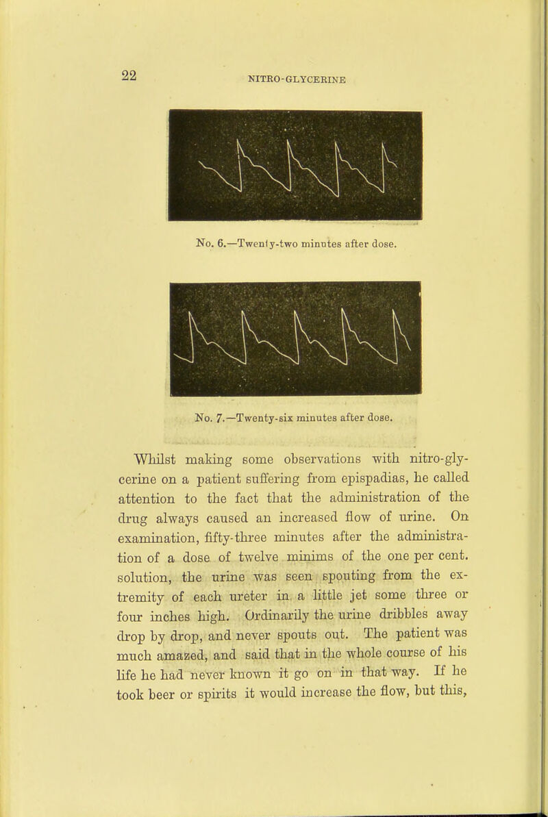 No. 6.—Twenly-two minutes after dose. No. 7-—Twenty-six minutes after dose. WMlst making some observations with nitro-gly- cerine on a patient suffering from epispadias, he called attention to the fact that the administration of the drug always caused an increased flow of urine. On examination, fifty-three minutes after the administra- tion of a dose of twelve minims of the one per cent, solution, the urine was seen spouting from the ex- tremity of each ureter in a little jet some three or four inches high. Ordinarily the urine dribbles away drop by drop, and never spouts out. The patient was much amazed, and said that in the whole course of his life he had never known it go on- in that way. If he took beer or spirits it would increase the flow, but this,