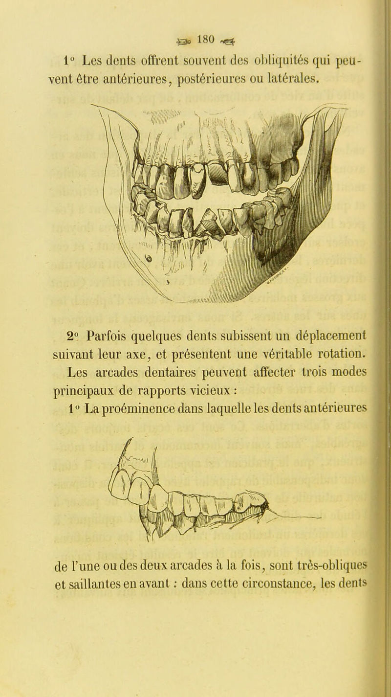 1° Les dents offrent souvent des oljliquités qui peu- vent être antérieures, postérieures ou latérales. 2° Parfois quelques dents subissent un déplacement suivant leur axe, et présentent une véritable rotation. Les arcades dentaires peuvent affecter trois modes principaux de rapports vicieux : 1 La proéminence dans laquelle les dents antérieures de l'une ou des deux arcades à la fois, sont très-obliques et saillantes en avant ; dans cette circonstance, les dents