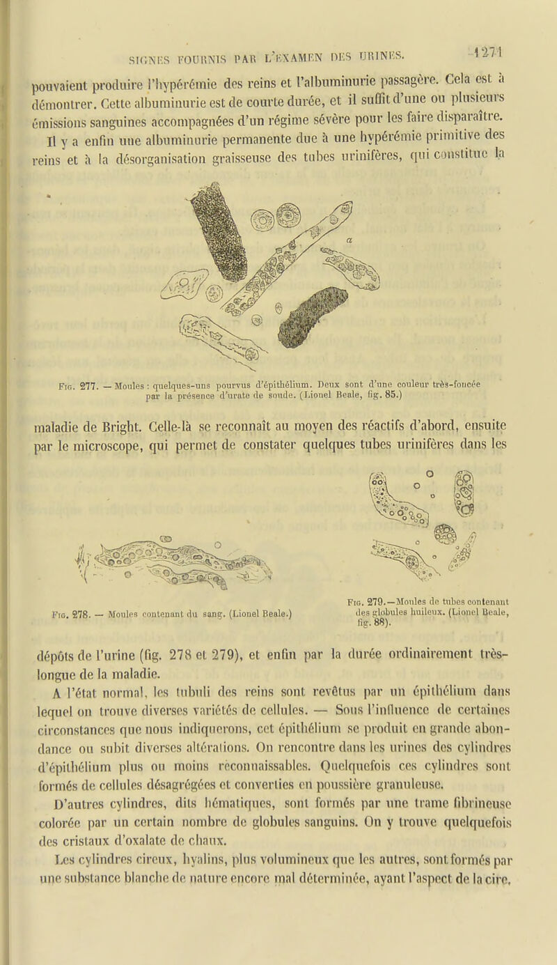 pouvaient produire i'hypérémie des reins et l'albuminurie passagère. Cela est à démontrer. Cette albuminurie est de courte durée, et il suffit d'une ou plusieurs émissions sanguines accompagnées d'un régime sévère pour les faire disparaître. Il y a enfm une albuminurie permanente due à une hypérémie primitive des reins et h la désorganisation graisseuse des tubes urinifères, qui conslitue la FiG. 277. — Moules : quelques-uus pourvus d'épitbélivim. Deux sont d'une couleur très-foucée par la présence d'urate de soude. (Lionel Beale, Dg. 85.) maladie de Bright. Celle-là se reconnaît au moyen des réactifs d'abord, ensuite par le microscope, qui permet de constater quelques tubes urinifères dans les Fio. 278. — Moules contenant du sang. (Lionel Beale.) Fm. 279.—Moules de tubes contenant des globules buileux. (Lionel Beale, fie.'88). dépôts de l'urine (fig. 278 et 279), et enfm par la durée ordinairement très- longue de la maladie. A l'état normal, les (ubuli des reins sont revêtus par un épilbélium dans lequel on trouve diverses variétés de cellules. — Sous l'influence de certaines circonstances que nous indiquerons, cet épithélium se produit en grande abon- dance ou subit diverses altérations. On rencontre dans les urines des cylindres d'épitbélium plus on moins réconnaissables. Quelquefois ces cylindres sont formés de cellules désagrégées et converties en poussière granuleuse. D'autres cylindres, dits liématiques, sont formés par une trame fd)rineuse colorée par un certain nombre de globules sanguins. On y trouve quelquefois des cristaux d'oxalate de chaux. Les cylindres cireux, hyalins, plus volumineux que les autres, sont formés par une substance blanche de nature encore mal déterminée, ayant l'aspect de la cire.