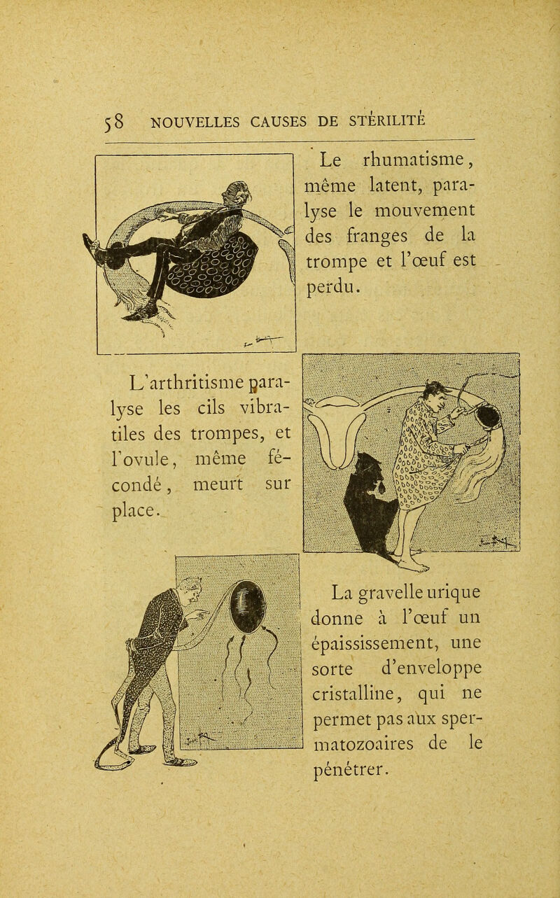 Le rhumatisme, même latent, para- lyse le mouvement des franges de la trompe et l'œuf est perdu. L'arthritisme para- lyse les cils vibra- tiles des trompes, et r ovule, même fé- condé , meurt sur place. La gravelleurique donne à l'œuf un épaississement, une sorte d'enveloppe cristalline, qui ne permet pas aux sper- matozoaires de le pénétrer.