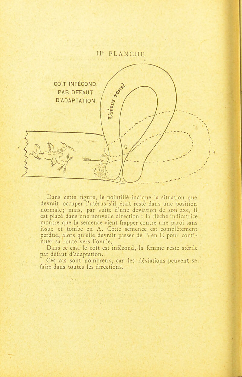 Il PLANCHE Dans cette figure, le pointillé indique la situation que devrait occuper l'utérus s'il était resté dans une position normale; mais, par suite d'une déviation de sou axe, il est placé dans une nouvelle direction : la flèche indicatrice montre que la semence vient frapper contre une paroi sans issue et tombe en A. Cette semence est complètement perdue, alors qu'elle devrait passer de B en C pour conti- nuer sa route vers l'ovule. Dans ce cas, le coït est infécond, la femme reste stérile par défaut d'adaptation. Ces cas sont nombreux, car les déviations peuvent se faire dans toutes les directions.
