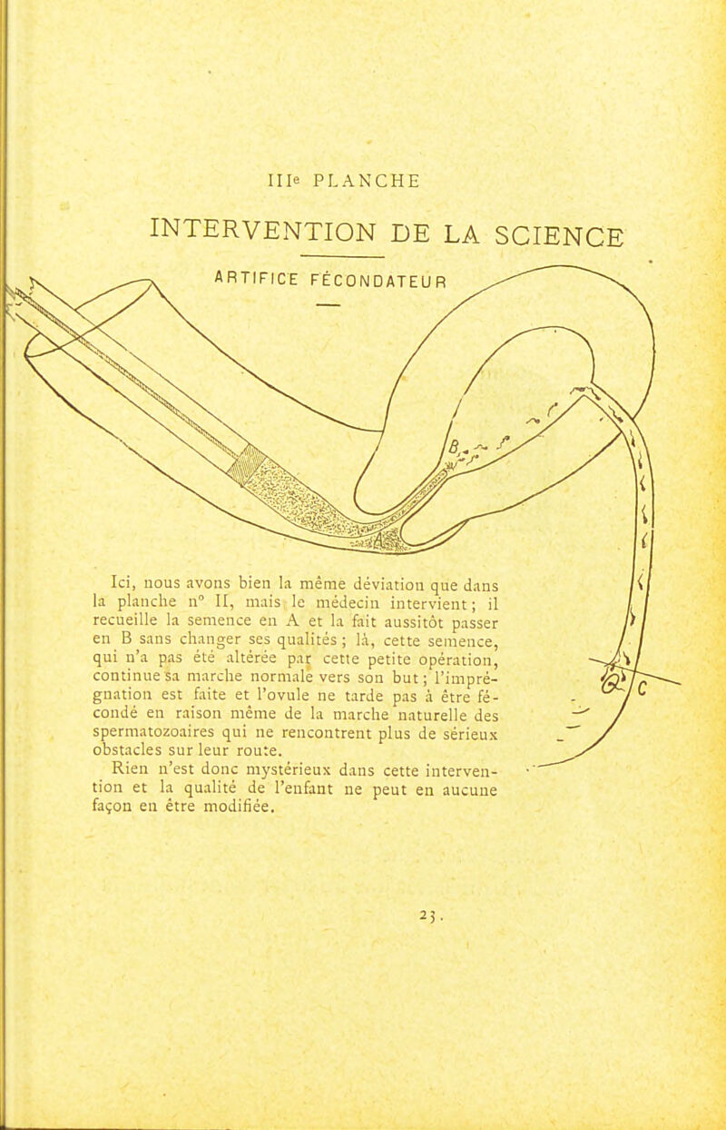 INTERVENTION DE LA SCIENCE Ici, nous avons bien la même déviation que dans la planche n° II, mais le médecin intervient ; il recueille la semence en A et la fait aussitôt passer en B saus changer ses qualités ; là, cette semence, qui n'a pas été altérée par cette petite opération, continue sa marche normale vers son but; l'impré- gnation est faite et l'ovule ne tarde pas à être fé- condé en raison même de la marche naturelle des spermatozoaires qui ne rencontrent plus de sérieux obstacles sur leur route. Rien n'est donc mystérieux dans cette interven- tion et la qualité de l'enfant ne peut en aucune façon en être modifiée. 23