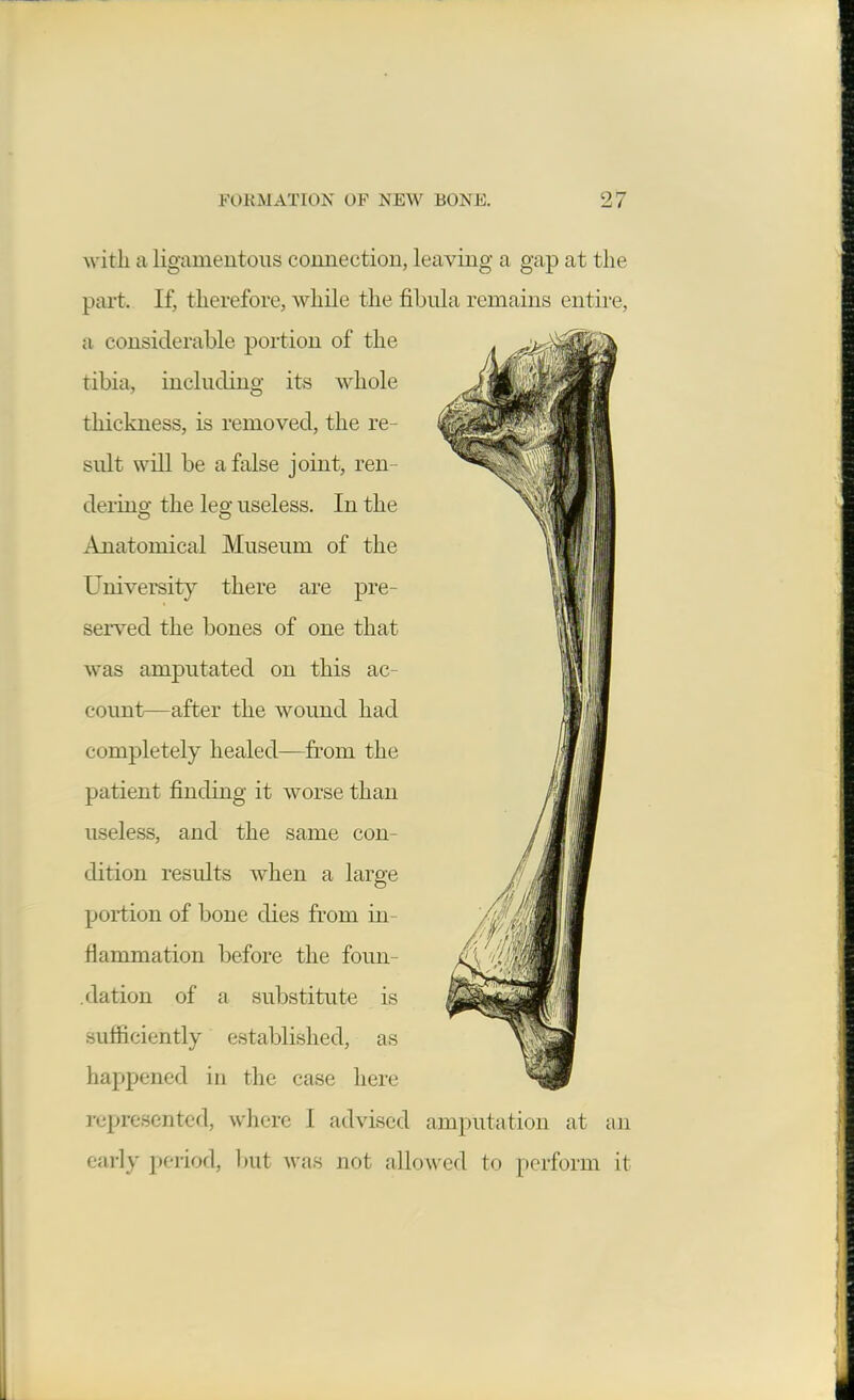 with a ligamentous connection, leaving a gap at the part. If, therefore, while the fibula remains entire, a considerable portion of the tibia, including its whole thickness, is removed, the re- sult will be a false joint, ren- dering the leg useless. In the Anatomical Museum of the University there are pre- served the bones of one that was amputated on this ac- count—after the wound had completely healed—from the patient finding it worse than useless, and the same con- dition results when a larg-e portion of bone dies from in- flammation before the foun- dation of a substitute is sufficiently established, as happened in the case here represented, where I advised amputation at an early period, l)ut was not allowed to perform it