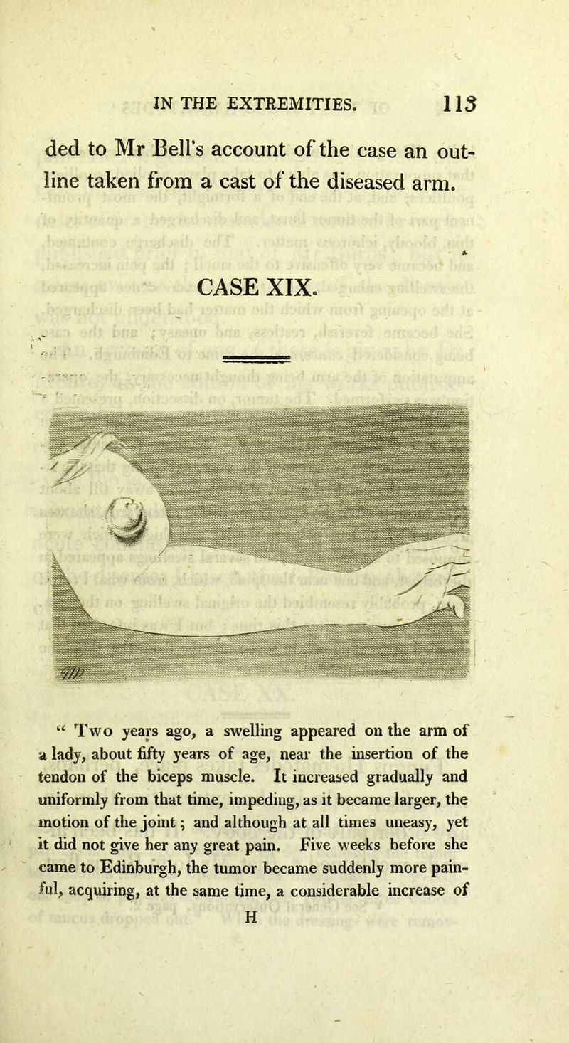 ded to Mr Bell’s account of the case an out- line taken from a cast of the diseased arm. CASE XIX. “ Two years ago, a swelling appeared on the arm of a lady, about fifty years of age, near the insertion of the tendon of the biceps muscle. It increased gradually and uniformly from that time, impeding, as it became larger, the motion of the joint; and although at all times uneasy, yet it did not give her any great pain. Five weeks before she came to Edinburgh, the tumor became suddenly more pain- ful, acquiring, at the same time, a considerable increase of H