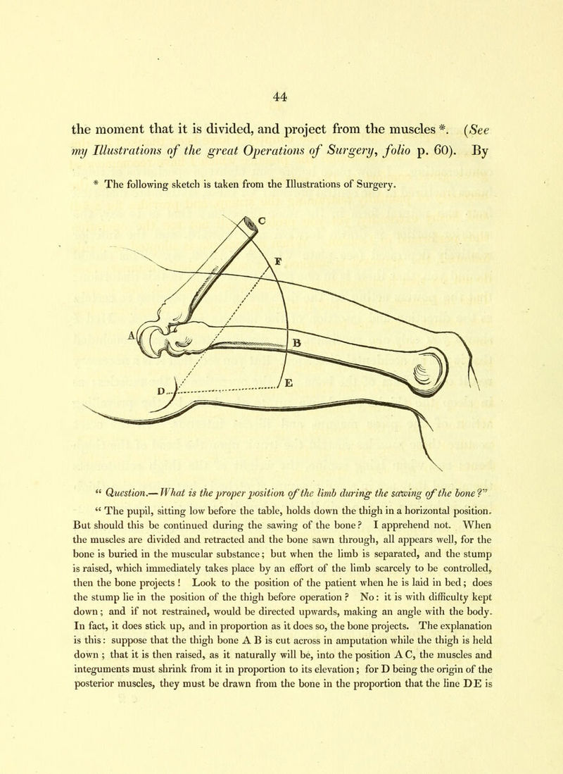 the moment that it is divided, and project from the muscles #. (See my Illustrations of the great Operations of Surgery, folio p. 60). By * The following sketch is taken from the Illustrations of Surgery. “ Question.— What is the proper position of the limb during the saving of the bone V “ The pupil, sitting low before the table, holds down the thigh in a horizontal position. But should this be continued during the sawing of the bone ? I apprehend not. When the muscles are divided and retracted and the bone sawn through, all appears well, for the bone is buried in the muscular substance; but when the limb is separated, and the stump is raised, which immediately takes place by an effort of the limb scarcely to be controlled, then the bone projects ! Look to the position of the patient when he is laid in bed; does the stump lie in the position of the thigh before operation ? No: it is with difficulty kept down; and if not restrained, would be directed upwards, making an angle with the body. In fact, it does stick up, and in proportion as it does so, the bone projects. The explanation is this: suppose that the thigh bone A B is cut across in amputation while the thigh is held down ; that it is then raised, as it naturally will be, into the position A C, the muscles and integuments must shrink from it in proportion to its elevation; for D being the origin of the posterior muscles, they must be drawn from the bone in the proportion that the line DE is