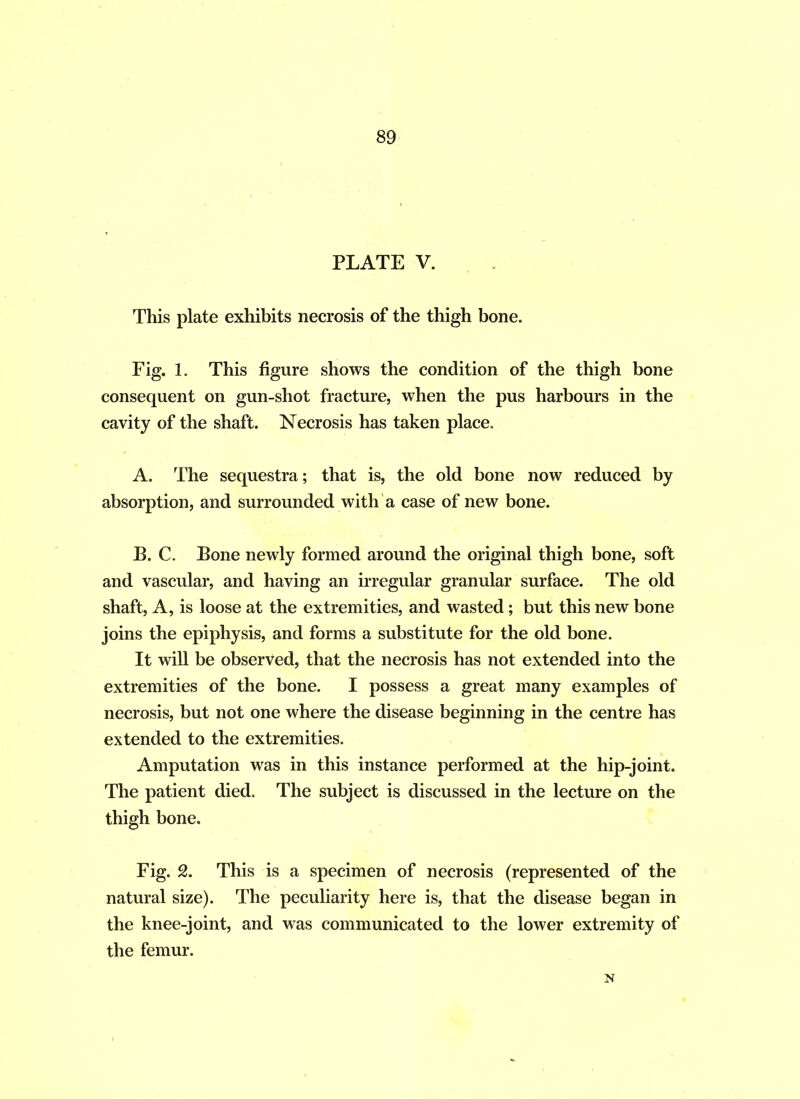 PLATE V. This plate exhibits necrosis of the thigh bone. Fig. 1. This figure shows the condition of the thigh bone consequent on gun-shot fracture, when the pus harbours in the cavity of the shaft. Necrosis has taken place. A. The sequestra; that is, the old bone now reduced by absorption, and surrounded with a case of new bone. B. C. Bone newly formed around the original thigh bone, soft and vascular, and having an irregular granular surface. The old shaft, A, is loose at the extremities, and wasted; but this new bone joins the epiphysis, and forms a substitute for the old bone. It will be observed, that the necrosis has not extended into the extremities of the bone. I possess a great many examples of necrosis, but not one where the disease beginning in the centre has extended to the extremities. Amputation was in this instance performed at the hip-joint. The patient died. The subject is discussed in the lecture on the thigh bone. Fig. 2. This is a specimen of necrosis (represented of the natural size). The peculiarity here is, that the disease began in the knee-joint, and was communicated to the lower extremity of the femur.