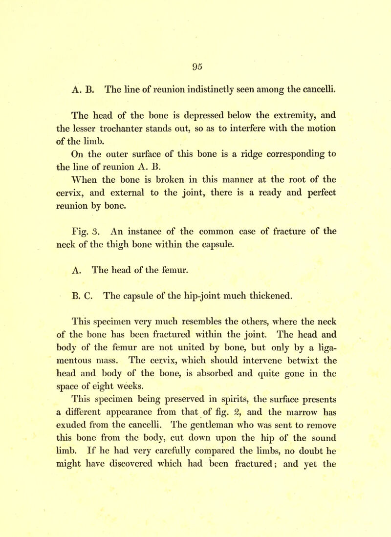 A. B. The line of reunion indistinctly seen among the cancelli. The head of the bone is depressed below the extremity, and the lesser trochanter stands out, so as to interfere with the motion of the limb. On the outer surface of this bone is a ridge corresponding to the line of reunion A. B. When the bone is broken in this manner at the root of the cervix, and external to the joint, there is a ready and perfect reunion by bone. Fig. 3. An instance of the common case of fracture of the neck of the thigh bone within the capsule. A. The head of the femur. B. C. The capsule of the hip-joint much thickened. This specimen very much resembles the others, where the neck of the bone has been fractured within the joint. The head and body of the femur are not united by bone, but only by a liga- mentous mass. The cervix, which should intervene betwixt the head and body of the bone, is absorbed and quite gone in the space of eight weeks. This specimen being preserved in spirits, the surface presents a different appearance from that of fig. 2, and the marrow has exuded from the cancelli. The gentleman who was sent to remove this bone from the body, cut down upon the hip of the sound limb. If he had very carefully compared the limbs, no doubt he might have discovered which had been fractured; and yet the