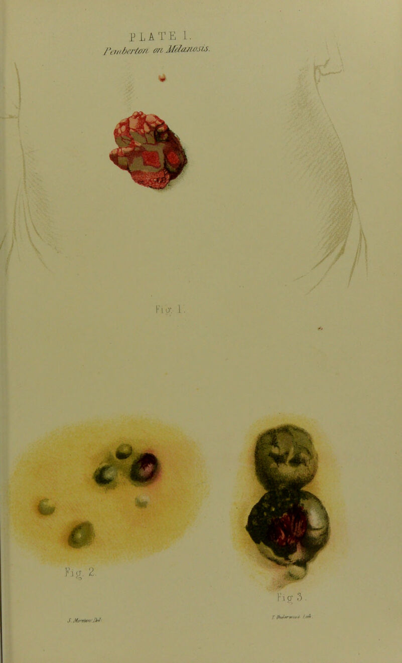 PLATE 1. Pemberton, m Melanosis. * F i o'. 1. Fig. 2 J. Morrton 'M F i p; 3 /' (fntlrrrtootl biff