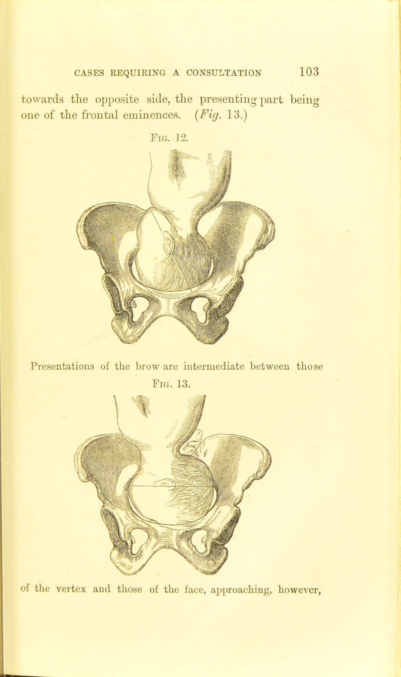 towards the opposite side, the presenting part being one of the fi'ontal eminences. {Fig. 13.) Fig. 12. Presentations of the brow are intermediate between those Fig. 13. of the vertex and those of the face, ai)proaching, however,