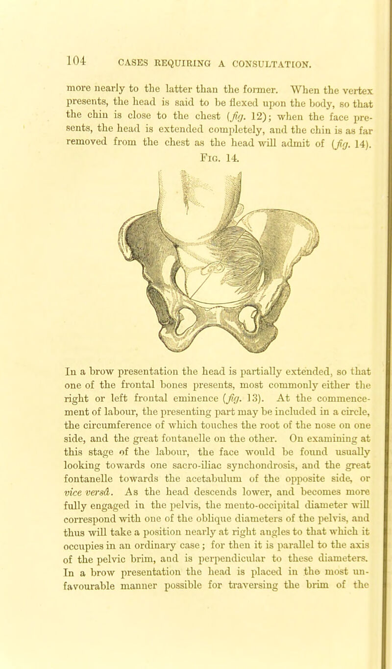 more nearly to the latter than the former. When the vertex presents, the head is said to be flexed upon the body, so that the chiu is close to the chest (fig. 12); when the face pre- sents, the head is extended completely, and the chin is as far removed from the chest as the head will admit of (fig. 14). Fig. 14 In a brow presentation the head is partially extended, so that one of the frontal bones presents, most commonly either the right or left frontal eminence {fig. 13). At the commence- ment of labour, the presenting part may be included in a circle, the circumference of wMcli touches the root of the nose on one side, and the great foutanelle on the other. On examining at this stage of the labour, the face would be foimd usually looking towards one sacro-iliac synchondrosis, and the great fontanelle towards the acetabulum of the opposite side, or vice versd. As the head descends lower, and becomes more fully engaged in the pehds, the meuto-occipital diameter will correspond with one of the oblique diameters of the peh4s, and thus will take a position nearly at right angles to that which it occupies in an ordinaiy case; for then it is parallel to the axis of the pelvic brim, and is j'erpendicular to these diameters. In a brow presentation the head is placed in the most im- favourable manner possible for ti-aversing the biim of the