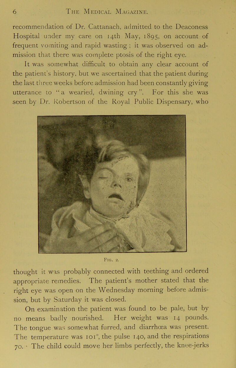 recommendation of Dr. Cattanach, admitted to the Deaconess Hospital under my care on 14th May, 1895, on account of frequent vomiting and rapid wasting ; it was observed on ad- mission that there was complete ptosis of the right eye. It was somewhat difficult to obtain any clear account of the patient’s history, but we ascertained that the patient during the last three weeks before admission had been constantly giving utterance to “a wearied, dwining cry”. For this she was seen by Dr. Robertson of the Royal Public Dispensary, who Fig. 2. thought it was probably connected with teething and ordered appropriate remedies. The patient’s mother stated that the right eye was open on the Wednesday morning before admis- sion, but by Saturday it was closed. On examination the patient was found to be pale, but by no means badly nourished. Her weight was 14 pounds. The tongue was somewhat furred, and diarrhoea was present. The temperature was ioi°, the pulse 140, and the respirations 70. • The child could move her limbs perfectly, the knee-jerks