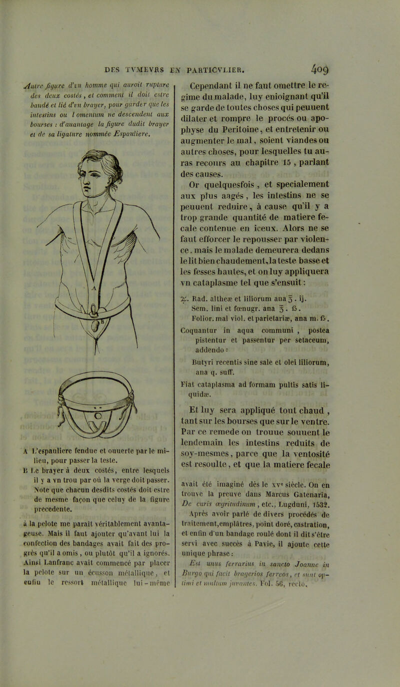 ^iiin' Jigure d'vti homme qui aurait ruplure des deux cosiés, et comment il doit entre bandé et lié d'vn braijer, pour garder que les intestins ou l omenium ne descendent aux bourses ; d'auantage la figure dudit braijer et de sa ligature nommée Espauliere. A L'espauliere fendue et ouuerte par le mi- lieu, pour passer la teste. El.ebrayerà deux cosiés, entre lesquels il y a vn trou par où la verge doit passer. Note que chacun desdits costés doit eslre de mesme façon que celuy de la figure précédente. ù la pelote me paraît véritablement avanta- geuse. Mais il faut ajouter qu'avant lui la fonfection des bandages avait fait des pro- grès qu'il a omis , ou plutôt qu'il a ignorés. Ainsi Lanfranc avait commencé par placer la pelote sur un écusson métallique, et eufiu le rossnrl mélalliquo lui-mémo Cependant il ne faut omettre le ré- gime du malade, luy enioignant quïl se g-arde de toutes choses qui peuuent dilater et rompre le procès ou apo- physe du Péritoine, et entretenir ou augmenter le mal, soient viandes ou autres choses, pour lesquelles tu au- ras recours au chapitre 15 , parlant des causes. Or quelquesfois , et spécialement aux pîus aagés, les intestins ne se peuuent réduire, à cause qu'il y a trop grande quantité de matière fé- cale contenue en iceux. Alors ne se faut efforcer le repousser par violen- ce . mais le malade demeurera dedans le lit bien chaudement,la teste basse et les fesses hautes, et on luy appliquera vn cataplasme tel que s'ensuit : K. Rad. althciE et liliorum ana g . ij. Sera, lini et fœnugr. ana 5.6. Folior. mal viol, etparietariae, ana m. ft. Coquantur in aqua coromuni , postca pistentur et passentur per setaceum, addendo -• Butyri recentis sine sale et olei liliorum, ana q. sulT. Fiat cataplasma ad formam pultis satis li- quidée. Et luy sera appliqué tout chaud , tant sur les bourses que sur le ventre. Par ce remède on trouue souuent le lendemain les intestins réduits de soy-mesmes, parce que la ventosité est resoulte, et que la matière fecale avait été imaginé dès le xv« siècle. On en trouve la preuve dans Marcus Gatenaria, De curis œgritudinum , etc., Lugduni, 1&32. Après avoir parlé de divers procédés de traitement,emplâtres, point doré, castration, et enfin d'un bandage roulé dont il dit s'être servi avec succès à Pavie, il ajoute cette unique phrase : Est unus ferrarius in sancto Joannc in Burgo qui facit bragerios ferreos, et mnt op- limi et mnltiim juvmites. Fol, 5G, roclo.