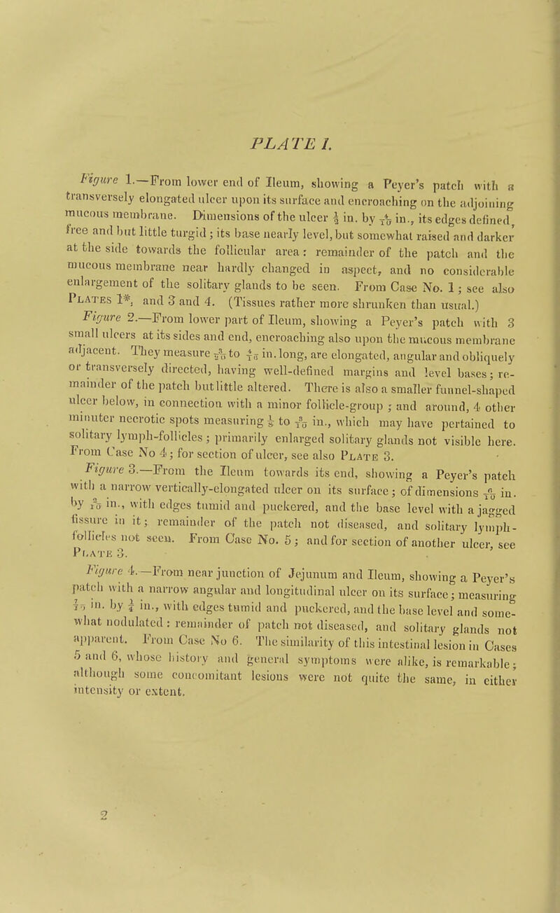Fzr/itre 1.—From lower end of Ileum, showing a Peyer's patcli witli a transversely elongated nicer upon its surface and encroaching (m the adjoining raucous membrane. Dimensions of the ulcer | in. by in., its edges defined, tree and hut little turgid; its base nearly level, but somewhat raised and darker at the side towards the follicular area: remainder of the patch and the mucous membrane near hardly changed in asj)ect, and no considerable enlargement of the solitary glands to be seen. From Case No. 1; see also Plates 1* and 3 and 4. (Tissues rather more shrunRen than usual.) Fifjure 2.—From lower part of Ileum, showing a Peyer's patch with 3 small ulcers at its sides and end, encroaching also upon the mucous membrane adjacent. They measure ^ to 4„ in. long, are elongated, angular and obliquely or transvei-sely directed, having well-defined margins and level bases; re- mainder of the patch but little altered. There is also a smaller funnel-shaped ulcer below, in connection with a minor follicle-group ; and around, 4 other minuter necrotic spots measuring i to in , which may have pertained to solitary lymph-follicles; primarily enlarged solitary glands not visible here. From Case No 4; for section of ulcer, see also Plate 3. Fiffure 3.—From the Ileum towards its end, showing a Peyer's patcli witli a narrow vertically-elongated ulcer on its surface; of dimensions in. by in., with edges tumid and puckered, and tiie base level with a jagged fissure in it; remainder of the patch not diseased, and solitary lymph- folheles not sceu. From Case No. 6; and for section of another ulcer see Pi-ate 3. Fif/itre 4.—From near junction of Jejunum and Ileum, showing a Peyer's patch with a narrow angular and longitudinal ulcer on its surface; measuring h, in. by I in., with edges tumid and puckered, and the base level and some- what nodulated : remainder of patch not diseased, and solitary glands not apl.arent. From Case No 6. Tiie similarity of this intestinal lesion in Cases 5 and 6, whose liistory and general symptoms were alike, is remarkable; although some concomitant lesions were not quite the same, in cither intensity or e.\tcnt.