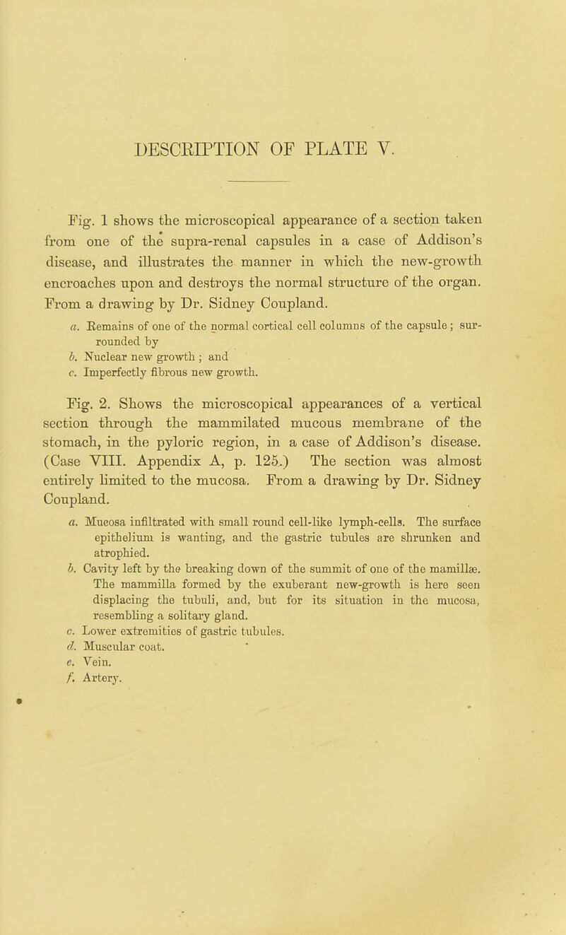 Fig. 1 shows the microscopical appearance of a section taken from one of the supra-renal capsules in a case of Addison’s disease, and illustrates the manner in which the new-growth encroaches upon and destroys the normal structure of the organ. From a drawing by Dr. Sidney Coupland. a. Eemains of one of the normal cortical cell columns of the capsule; sur- rounded by b. Nuclear new growth ; and c. Imperfectly fibrous new growth. Fig. 2. Shows the microscopical appearances of a vertical section through the mammilated mucous membrane of the stomach, in the pyloric region, in a case of Addison’s disease. (Case VIII. Appendix A, p. 125.) The section was almost entirely limited to the mueosa. From a drawing by Dr. Sidney Coupland. a. Mucosa infiltrated with small round cell-like lymph-cells. The surface epithelium is wanting, and the gastric tubules are shrunken and atrophied. b. Cavity left by the breaking down of the summit of one of the mamillse. The mammilla formed by the exuberant new-growth is here seen displacing the tubuli, and, but for its situation in the mucosa, resembling a solitary gland. c. Lower extremities of gastric tubules. d. Muscular coat. e. Vein. /'. Artery.