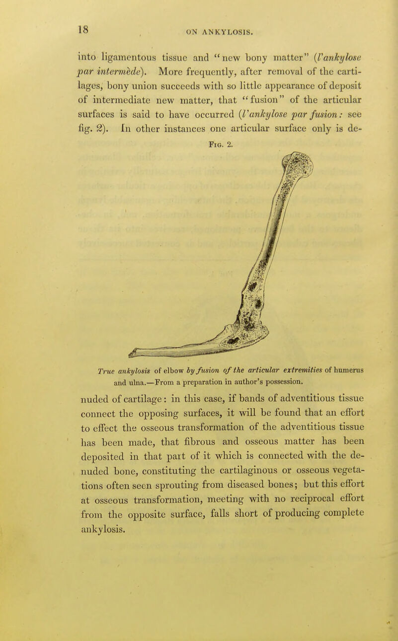 into ligamentous tissue and new bony matter {Vankylose par intermede). More frequently, after removal of the carti- lages, bony union succeeds with so little appearance of deposit of intermediate new matter, that fusion of the articular surfaces is said to have occurred {Vankylose par fusion: see fig. 2). In other instances one articular surface only is de- FiG. 2. True ankylosis of elbow by fusion of the articular extremities of humerus and ulna.—From a preparation in author's possession, nuded of cartilage: in this case, if bands of adventitious tissue connect the opposing surfaces, it will be found that an effort to effect the osseous transformation of the adventitious tissue has been made, that fibrous and osseous matter has been deposited in that pait of it which is connected with the de- nuded bone, constituting the cartilaginous or osseous vegeta- tions often seen sprouting from diseased bones; but this effort at osseous transformation, meeting with no reciprocal effort from the opposite surface, falls short of producing complete ankylosis.