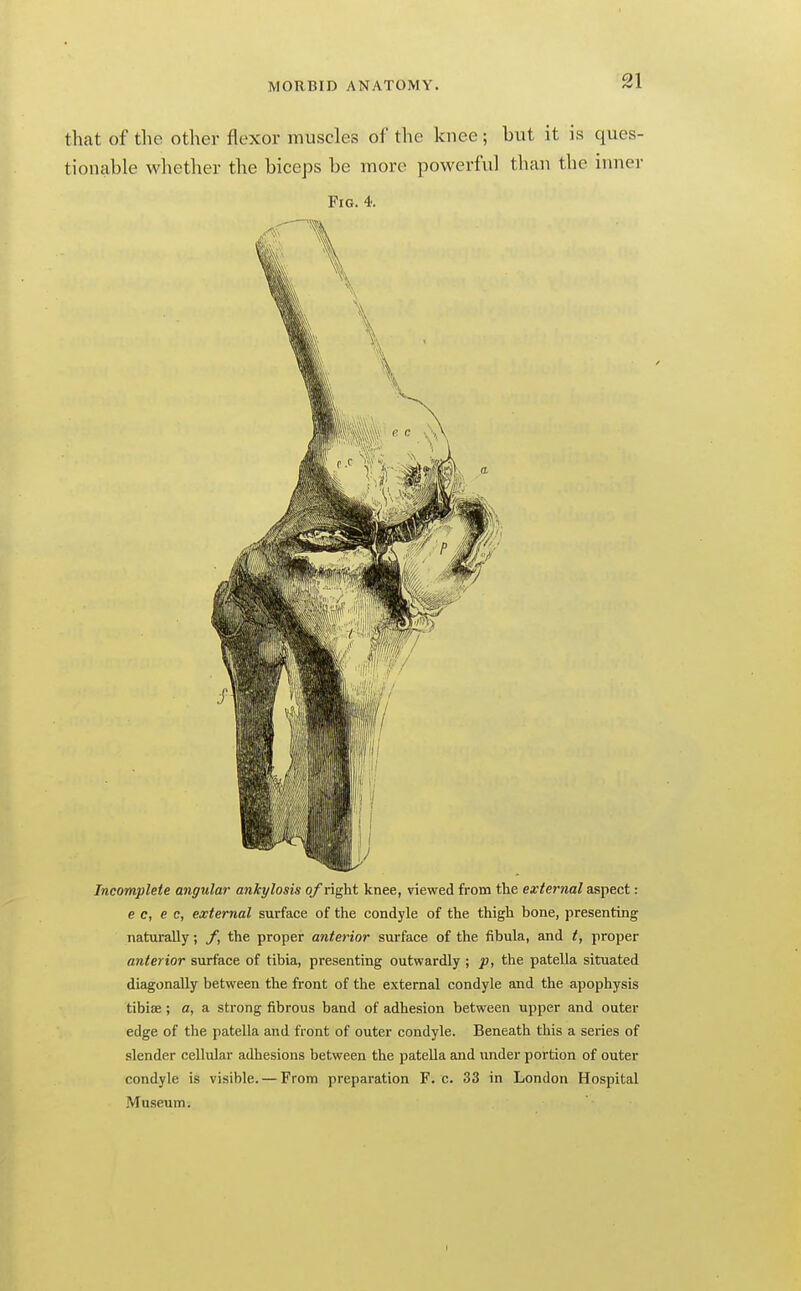 thcat of the other flexor muscles of the knee ; but it is ques- tionable wliether the biceps be more powerful than the inner Fig. 4. Incomplete angular ankylosis 0/right knee, viewed from the external aspect: e c, e c, external surface of the condyle of the thigh bone, presenting naturally; f, the proper anterior surface of the fibula, and t, proper anterior surface of tibia, presenting outwardly; p, the patella situated diagonally between the front of the external condyle and the apophysis tibiae ; a, a strong fibrous band of adhesion between upper and outer edge of the patella and front of outer condyle. Beneath this a series of slender cellular adhesions between the patella and under portion of outer condyle is visible. — From preparation F. c. 33 in London Hospital Museum.