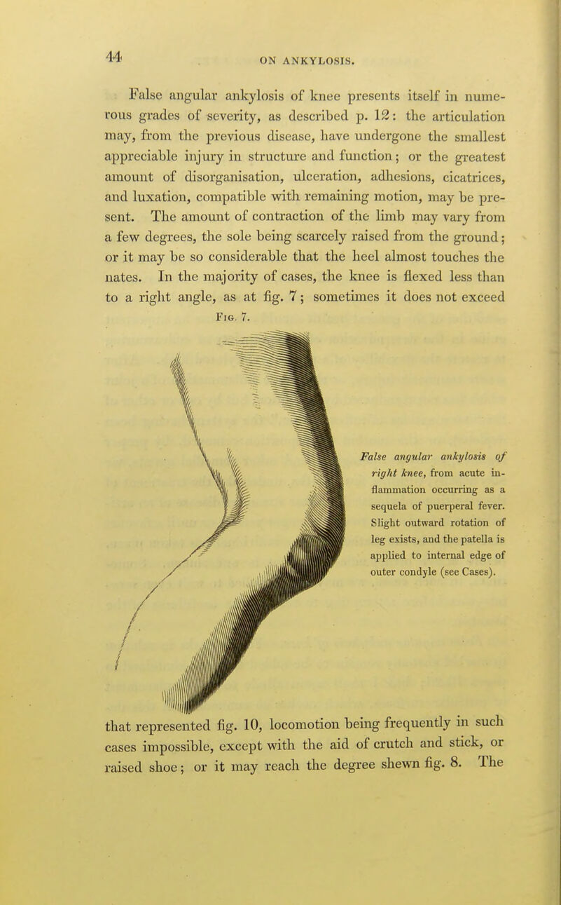 ON ANKYLOSIS. False angular ankylosis of knee presents itself in nume- rous grades of severity, as described p. 12: the articulation may, from the previous disease, have undergone the smallest appreciable injury in structure and function; or the greatest amount of disorganisation, ulceration, adhesions, cicatrices, and luxation, compatible with remaining motion, may be pre- sent. The amount of contraction of the limb may vary from a few degrees, the sole being scarcely raised from the ground; or it may be so considerable that the heel almost touches the nates. In the majority of cases, the knee is flexed less than to a right angle, as at fig. 7; sometimes it does not exceed Fig. 7. False angular ankylosis of right knee, from acute in- flammation occurring as a sequela of puerperal fever. Slight outward rotation of leg exists, and the patella is applied to internal edge of outer condyle (see Cases). that represented fig. 10, locomotion being frequently in such cases impossible, except with the aid of crutch and stick, or raised shoe; or it may reach the degree shewn fig. 8. The