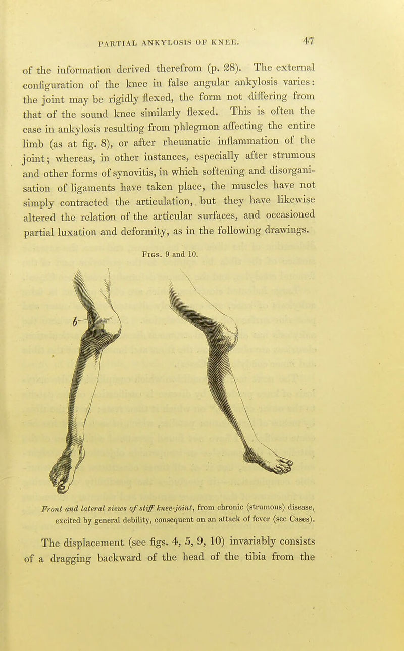 of the information derived therefrom (p. 28). The external configuration of the knee in false angular ankylosis varies: the joint may be rigidly flexed, the form not diff'ering from that of the sound knee similarly flexed. This is often the case in ankylosis resulting from phlegmon affecting the entire limb (as at fig. 8), or after rheumatic inflammation of the joint; whereas, in other instances, especially after strumous and other forms of synovitis, in which softening and disorgani- sation of ligaments have taken place, the muscles have not simply contracted the articulation, but they have likewise altered the relation of the articular surfaces, and occasioned partial luxation and deformity, as in the following drawings. Figs. 9 and 10. Front and lateral views of stiff knee-joint, from chronic (strumous) disease, excited by general debility, consequent on an attack of fever (see Cases). The displacement (see figs. 4, 5, 9, 10) invariably consists of a dragging backward of the head of the tibia from the