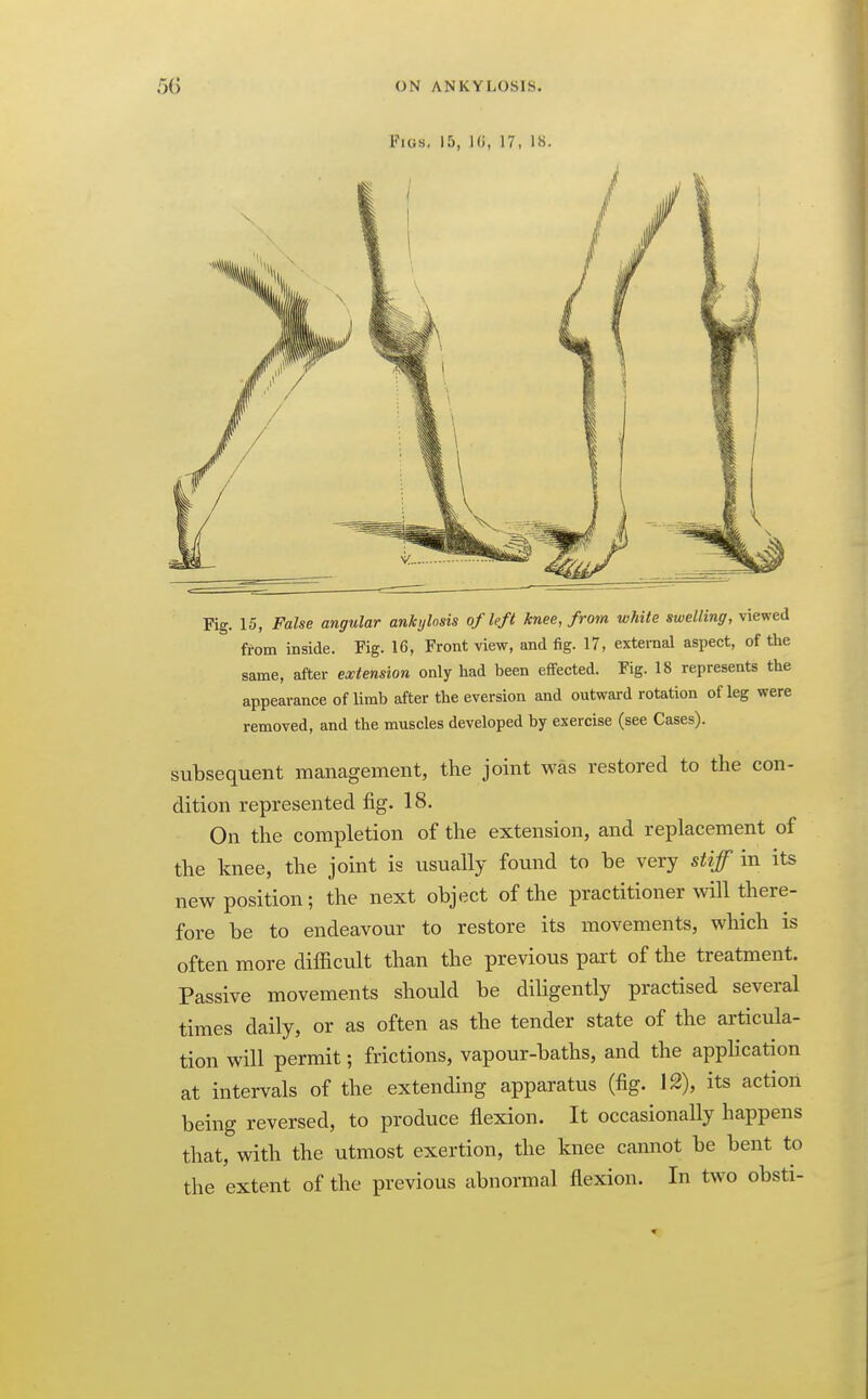 Fig. 15, False angular ankylosis of left knee, from white swelling, viewed from inside. Fig. 16, Front view, and fig. 17, external aspect, of the same, after extension only had been eflfected. Fig. 18 represents the appearance of limb after the eversion and outward rotation of leg were removed, and the muscles developed by exercise (see Cases). subsequent management, the joint was restored to the con- dition represented fig. 18. On the completion of the extension, and replacement of the knee, the joint is usually found to be very stijf in its new position; the next object of the practitioner will there- fore be to endeavour to restore its movements, which is often more difficult than the previous part of the treatment. Passive movements should be diligently practised several times daily, or as often as the tender state of the articula- tion will permit; frictions, vapour-baths, and the appHcation at intervals of the extending apparatus (fig. 12), its action being reversed, to produce flexion. It occasionally happens that, with the utmost exertion, the knee cannot be bent to the extent of the previous abnormal flexion. In two obsti-