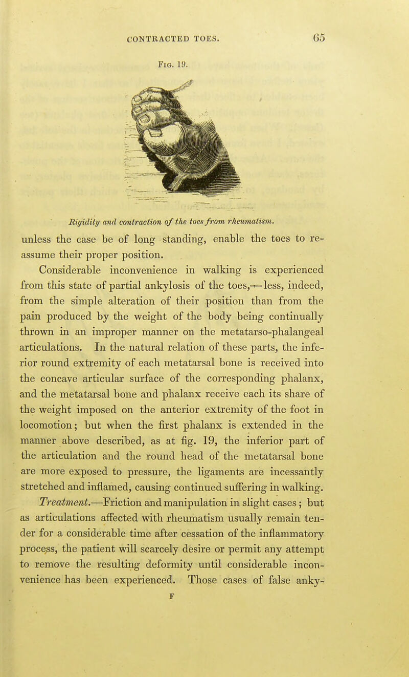 Fig. 19. Rigidity and contraction of the toes from rheumatism. unless the case be of long standing, enable the toes to re- assume their proper position. Considerable inconvenience in walking is experienced from this state of partial ankylosis of the toes,-^less, indeed, from the simple alteration of their position than from the pain produced by the weight of the body being continually thrown in an improper manner on the metatarso-phalangeal articulations. In the natural relation of these parts, the infe- rior round extremity of each metatarsal bone is received into the concave articular surface of the corresponding phalanx, and the metatarsal bone and phalanx receive each its share of the weight imposed on the anterior extremity of the foot in locomotion; but when the first phalanx is extended in the manner above described, as at fig. 19, the inferior part of the articulation and the round head of the metatarsal bone are more exposed to pressure, the ligaments are incessantly stretched and inflamed, causing continued sufiering in walking. Treatment.—Friction and manipulation in slight cases; but as articulations affected with rheumatism usually remain ten- der for a considerable time after cessation of the inflammatory process, the patient will scarcely desire or permit any attempt to remove the resulting deformity until considerable incon- venience has been experienced. Those cases of false anky- F