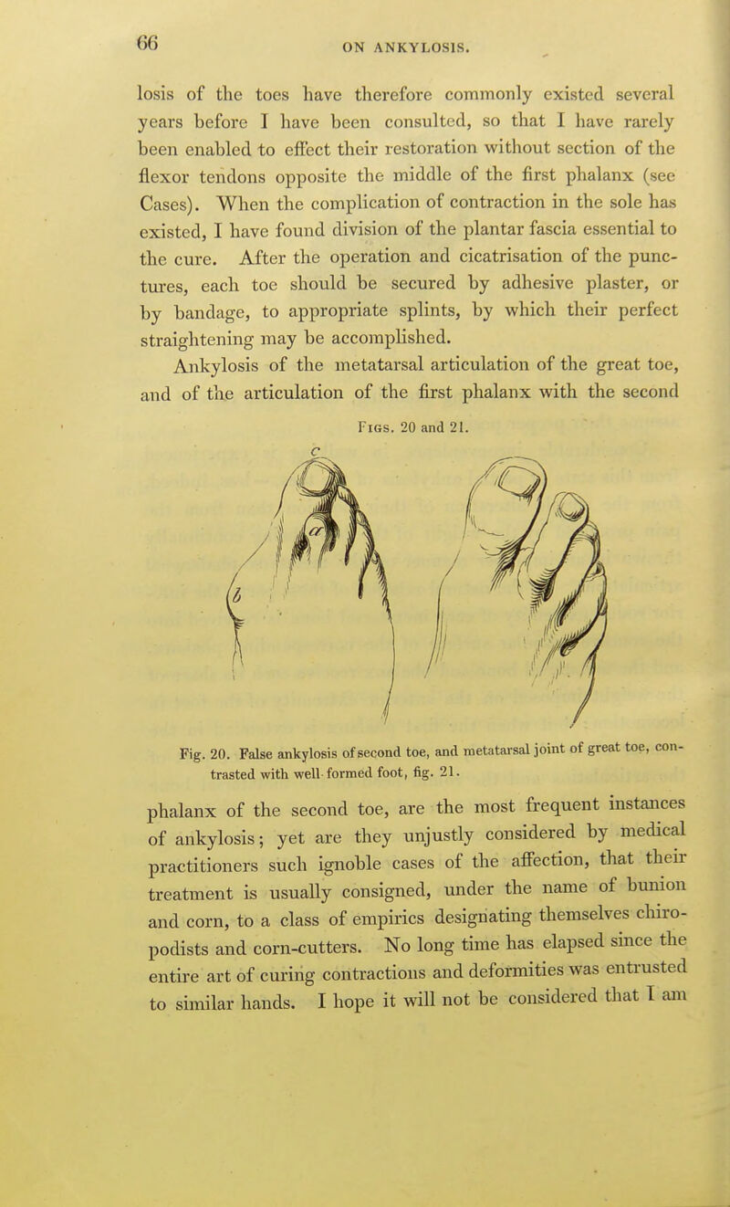 losis of the toes have therefore commonly existed several years before I have been consulted, so that I have rarely been enabled to efiect their restoration without section of the flexor tendons opposite the middle of the first phalanx (see Cases). When the complication of contraction in the sole has existed, I have found division of the plantar fascia essential to the cure. After the operation and cicatrisation of the punc- tures, each toe should be secured by adhesive plaster, or by bandage, to appropriate splints, by which their perfect straightening may be accomplished. Ankylosis of the metatarsal articulation of the great toe, and of the articulation of the first phalanx with the second Figs. 20 and 21. Fig. 20. False ankylosis of second toe, and metatarsal joint of great toe, con- trasted with well formed foot, fig. 21. phalanx of the second toe, are the most frequent instances of ankylosis; yet are they unjustly considered by medical practitioners such ignoble cases of the afiection, that their treatment is usually consigned, under the name of bunion and corn, to a class of empirics designating themselves chiro- podists and corn-cutters. No long time has elapsed since the entire art of curing contractions and deformities was entrusted to similar hands. I hope it will not be considered that I am