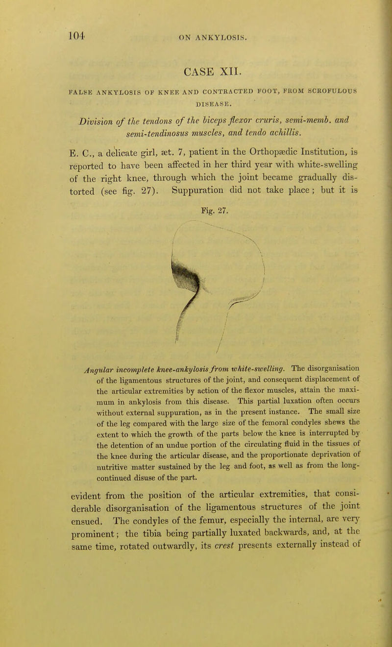 CASE XII. FALSE ANKYLOSIS OF KNEK AND CONTRACTED FOOT, FROM SCROFULOUS DISEASE. Division of the tendons of the liccps flexor cruris, semi-memh. and semi-tendinosus muscles, and tendo achillis. E. C, a delicate girl, aet. 7, patient in the OrthopEedic Institution, is reported to have been affected in her third year with white-swelling of the right knee, through which the joint became gradually dis- torted (see fig. 27). Suppuration did not take place; but it is Fig. 27. Angular incomplete knee-ankylosis from white-swelling. The disorganisation of the ligamentous structures of the joint, and consequent displacement of the articular extremities by action of the flexor muscles, attain the maxi- mum in ankylosis from this disease. This partial luxation often occurs ■without external suppuration, as in the present instance. The small size of the leg compared with the large size of the femoral condyles shews the extent to which the growth of the parts below the knee is interrupted by the detention of an undue portion of the circulating fluid in the tissues of the knee during the articular disease, and the proportionate deprivation of nutritive matter sustained by the leg and foot, as well as from the long- continued disuse of the part. evident from the position of the articular extremities, that consi- derable disorganisation of the ligamentous structures of the joint ensued. The condyles of the femur, especially the internal, are verj- prominent; the tibia being partially luxated backwards, and, at the same time, rotated outwardly, its crest presents externally instead of