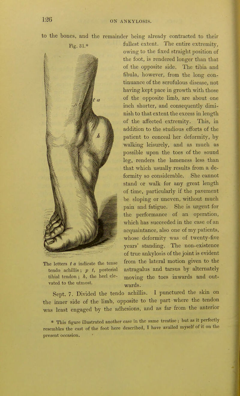 to the bones, and the remainder being already contracted to their Fig. 31.* fullest extent. The entire extremity, owing to the fixed straight position of the foot, is rendered longer than that of the opposite side. I'he tibia and fibula, however, from the long con- tinuance of the scrofulous disease, not having kept pace in growth with those of the opposite limb, are about one inch shorter, and consequently dimi- nish to that extent the excess in length of the affected extremity. This, in addition to the studious efforts of the patient to conceal her deformity, by walking leisurely, and as much as possible upon the toes of the sound leg, renders the lameness less than that which usually restdts from a de- formity so considerable. She cannot stand or waUc for any great length of time, particularly if the pavement be sloping or uneven, without much pain and fatigue. She is urgent for the performance of an operation, which has succeeded in the case of an acquaintance, also one of my patients, whose deformit}^ was of twenty-five years' standing. The non-existence of true ankylosis of the joint is evident from the lateral motion given to the astragalus and tarsus by alternately moving the toes inwards and out- wards. Sept, 7. Divided the tendo achillis. I punctured the skm on the inner side of the limb, opposite to the part where the tendon was least engaged by the adhesions, and as far from the anterior * This figure iUustrated another case in the same treatise ; but as it perfectly resembles the cast of the foot here described, I have availed myself of it on the present occa.sion, ' The letters t a indicate the tense tendo achillis; p t, posterial tibial tendon ; h, the heel ele- vated to the utmost.