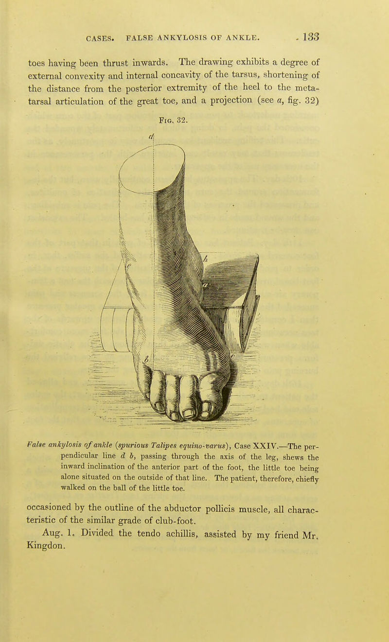 toes having been thrust inwards. The drawing exhibits a degree of external convexity and internal concavity of the tarsus, shortening of the distance from the posterior extremity of the heel to the meta- tarsal articulation of the great toe, and a projection (see a, fig. 32) Fig. 32. False ankylosis ofanlcle {spurious Talipes equino-varus), Case XXIV.—^The per- pendicular line d b, passing through the axis of the leg, shews the inward inclination of the anterior part of the foot, the little toe being alone situated on the outside of that line. The patient, therefore, chiefly- walked on the ball of the little toe. occasioned by the outline of the abductor polHcis muscle, all charac- teristic of the similar grade of club-foot. Aug. 1. Divided the tendo achillis, assisted by my friend Mr. Kingdon.