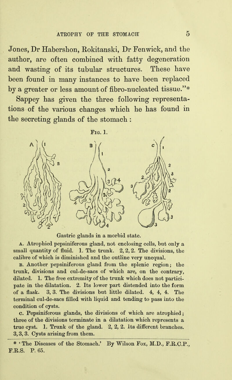 Jones, Dr Haberslion, Rokitanski, Dr Fenwick, and the author, are often combined with fatty degeneration and wasting of its tubular structures. These have been found in many instances to have been replaced by a greater or less amount of fibro-nucleated tissue.* Sappey has given the three following representa- tions of the various changes which he has found in the secreting glands of the stomach : Fm. 1. Gastric glands in a morbid state. A. Atrophied pepsiniferous gland, not enclosing cells, but only a small quantity of fluid. 1. The trunk. 2, 2, 2. The divisions, the calibre of which is diminished and the outline very unequal. B. Another pepsiniferous gland from the splenic region; the trunk, divisions and cul-de-sacs of which are, on the contrary, dilated. 1. The free extremity of the trunk which does not partici- pate in the dilatation. 2. Its lower part distended into the form of a flask. 3, 3. The divisions but little dilated. 4, 4, 4. The terminal cul-de-sacs filled with liquid and tending to pass into the condition of cysts. c. Pepsiniferous glands, the divisions of which are atrophied ; three of the divisions terminate in a dilatation which represents a true cyst. 1. Trunk of the gland. 2, 2, 2. Its different branches. 3,3, 3. Cysts arising fi'om them. * ' The Diseases of the Stomach.' By Wilson Fox, M.D., F.R.C.P., F.KS. P. 65.