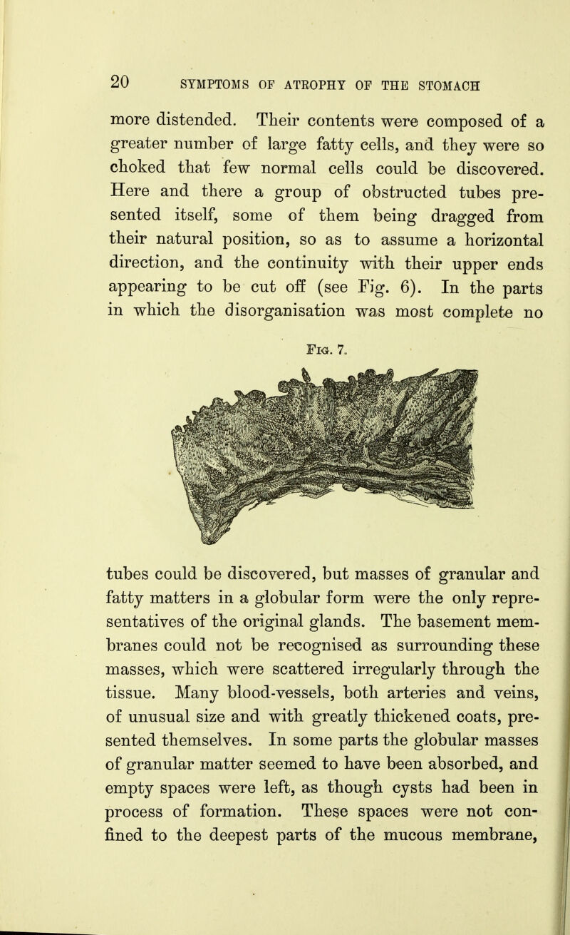 more distended. Their contents were composed of a greater number of large fatty cells, and they were so choked that few normal cells could be discovered. Here and there a group of obstructed tubes pre- sented itself, some of them being dragged from their natural position, so as to assume a horizontal direction, and the continuity with their upper ends appearing to be cut off (see Fig. 6). In the parts in which the disorganisation was most complete no Fi<j. 7, tubes could be discovered, but masses of granular and fatty matters in a globular form were the only repre- sentatives of the original glands. The basement mem- branes could not be recognised as surrounding these masses, which were scattered irregularly through the tissue. Many blood-vessels, both arteries and veins, of unusual size and with greatly thickened coats, pre- sented themselves. In some parts the globular masses of granular matter seemed to have been absorbed, and empty spaces were left, as though cysts had been in process of formation. These spaces were not con- fined to the deepest parts of the mucous membrane,