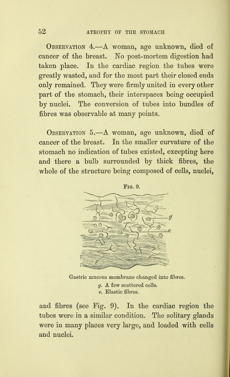 Observation 4.—A woman, age unknown, died of cancer of tlie breast. No post-mortem digestion liad taken place. In tlie cardiac region the tubes were greatly wasted, and for the most part their closed ends only remained. They were firmly united in every other part of the stomach, their interspaces being occupied by nuclei. The conversion of tubes into bundles of fibres was observable at many points. Observation 5.—A woman, age unknown, died of cancer of the breast. In the smaller curvature of the stomach no indication of tubes existed, excepting here and there a bulb surrounded by thick fibres, the whole of the structure being composed of cells, nuclei. Fia. 9. Gastric mucous membrane changed into fibres. g. A few scattered cells. e. Elastic fibres. and fibres (see Fig. 9). In the cardiac region the tubes were in a similar condition. The solitary glands were in many places very large, and loaded with cells and nuclei.